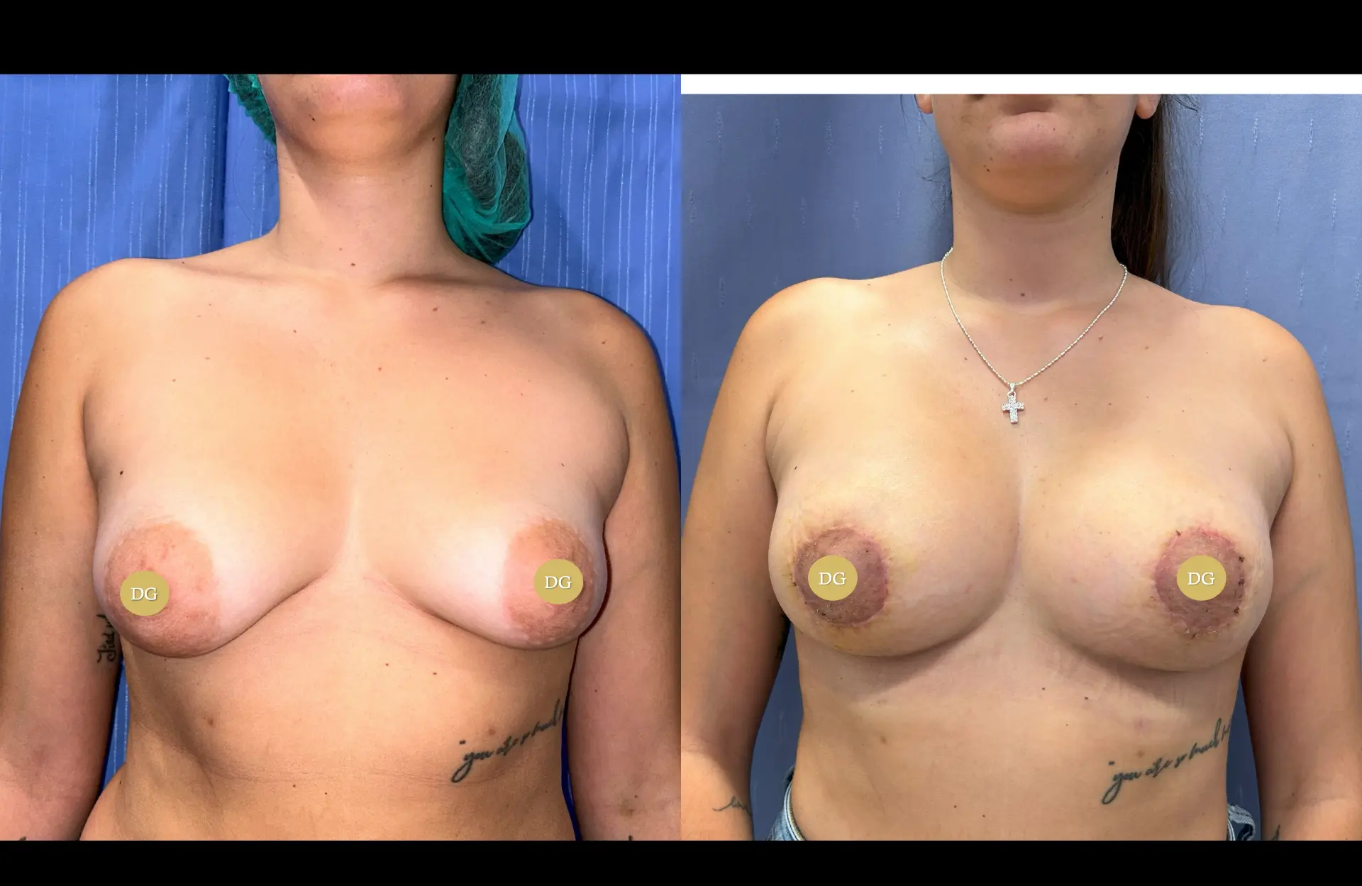 Caso 1 — Mama tuberosa — Antes e depois — vista frontal