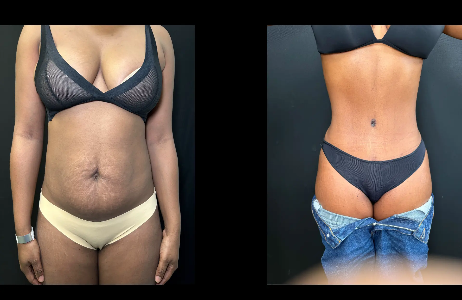 Caso 3 — Lipoabdominoplastia — Antes e depois — vista frontal