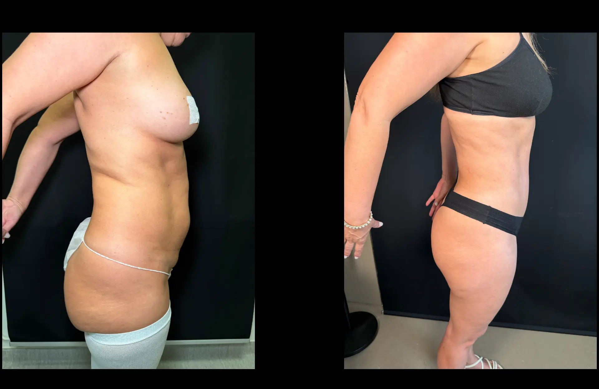 Caso 2 — Lipoabdominoplastia — Antes e depois — vista de perfil