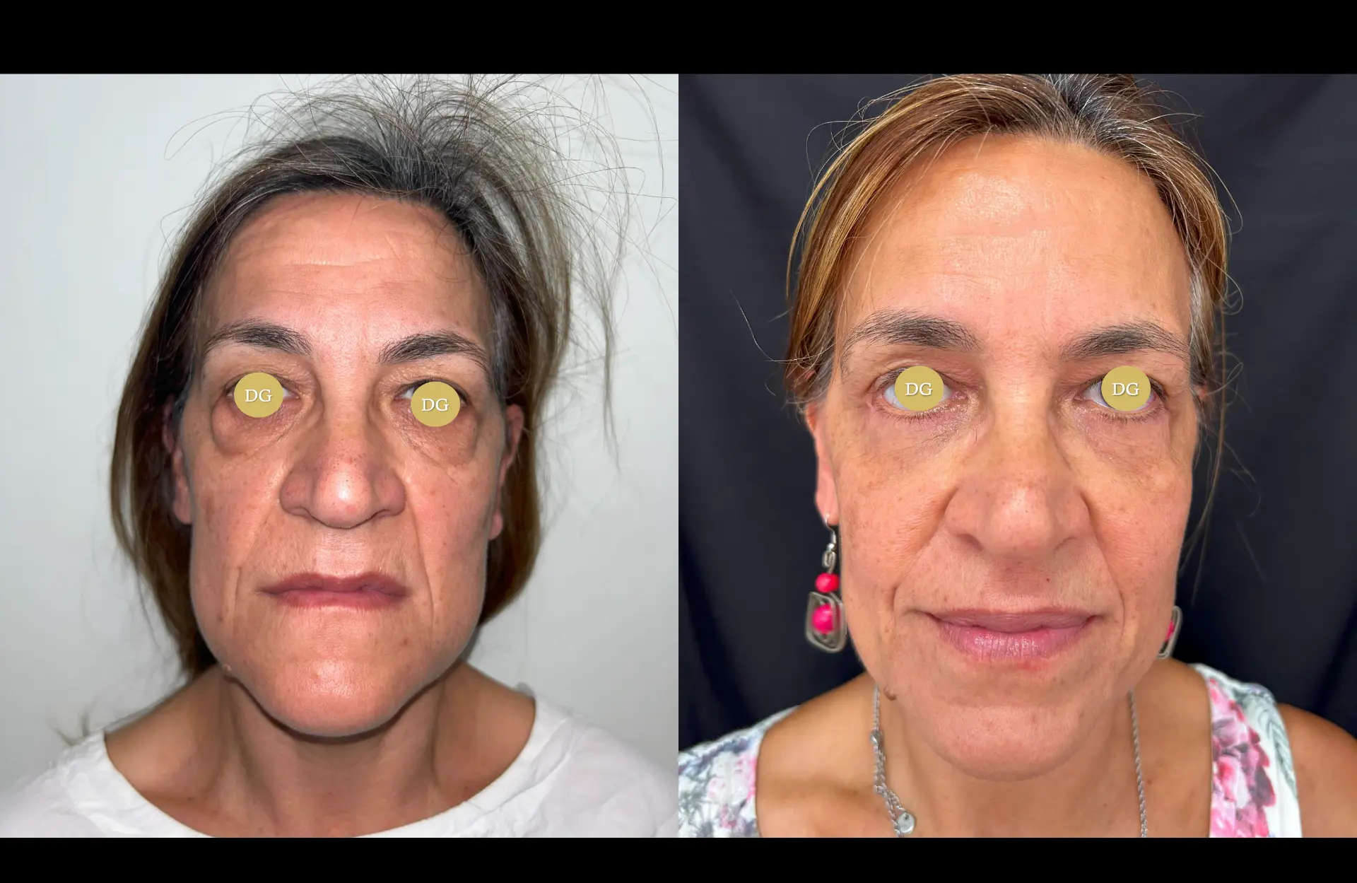 Caso 2 — Blefaroplastia — Antes e depois — vista frontal