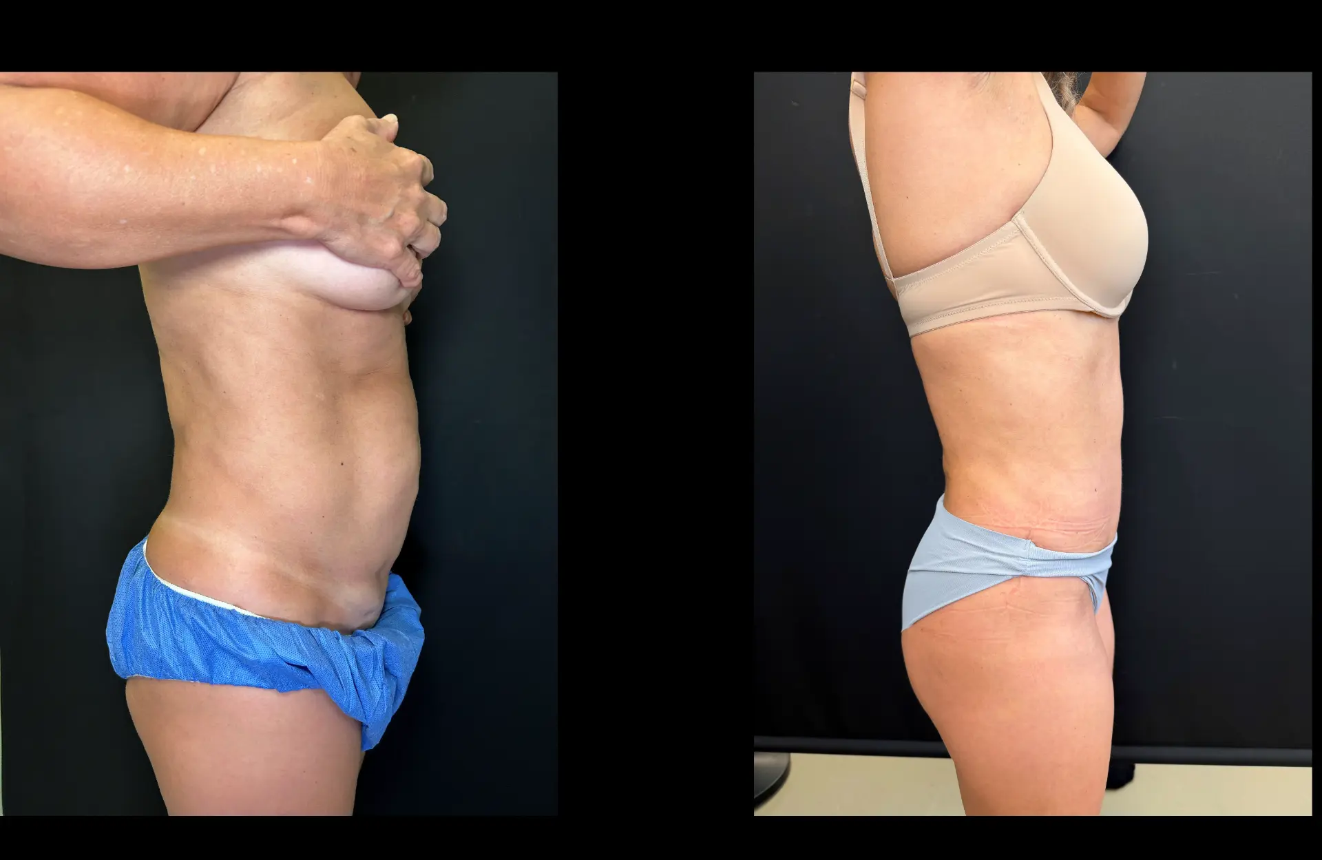 Caso 5 — Lipoabdominoplastia — Antes e depois — vista de perfil