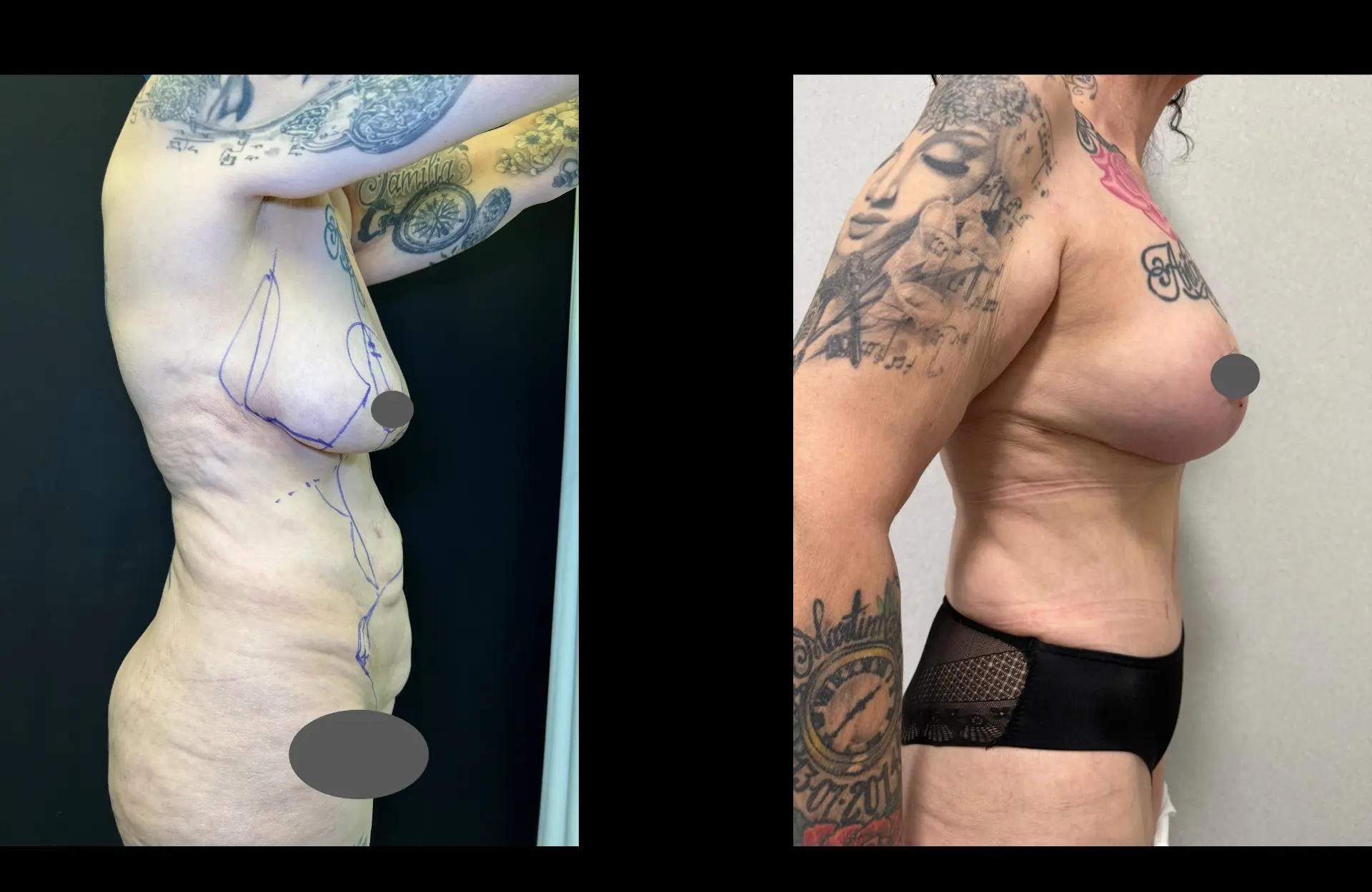 Caso 4 — Cirurgia combinada — Antes e depois — vista de perfil