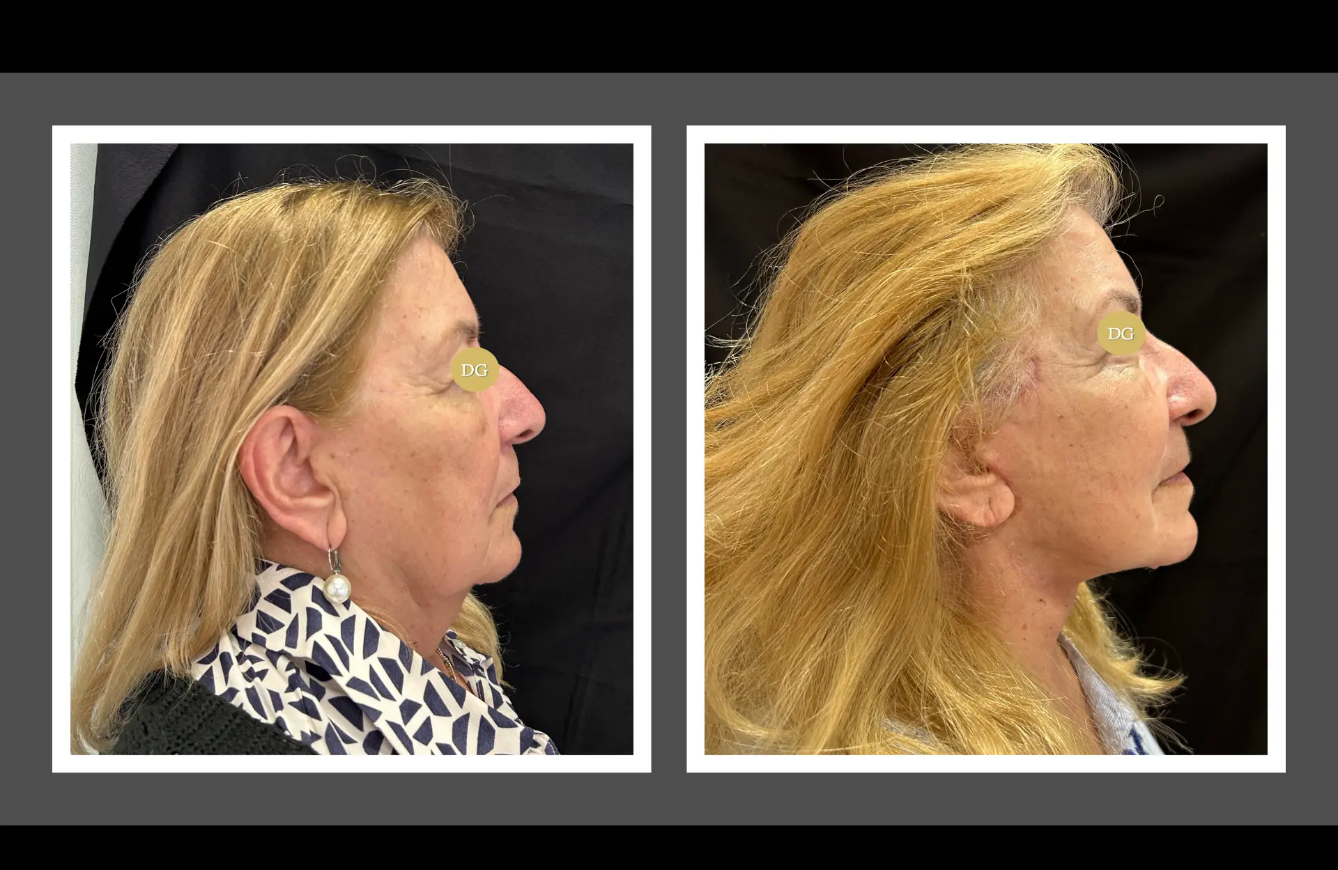 Caso 2 — Facelift cervico-facial — Antes e depois — vista de perfil