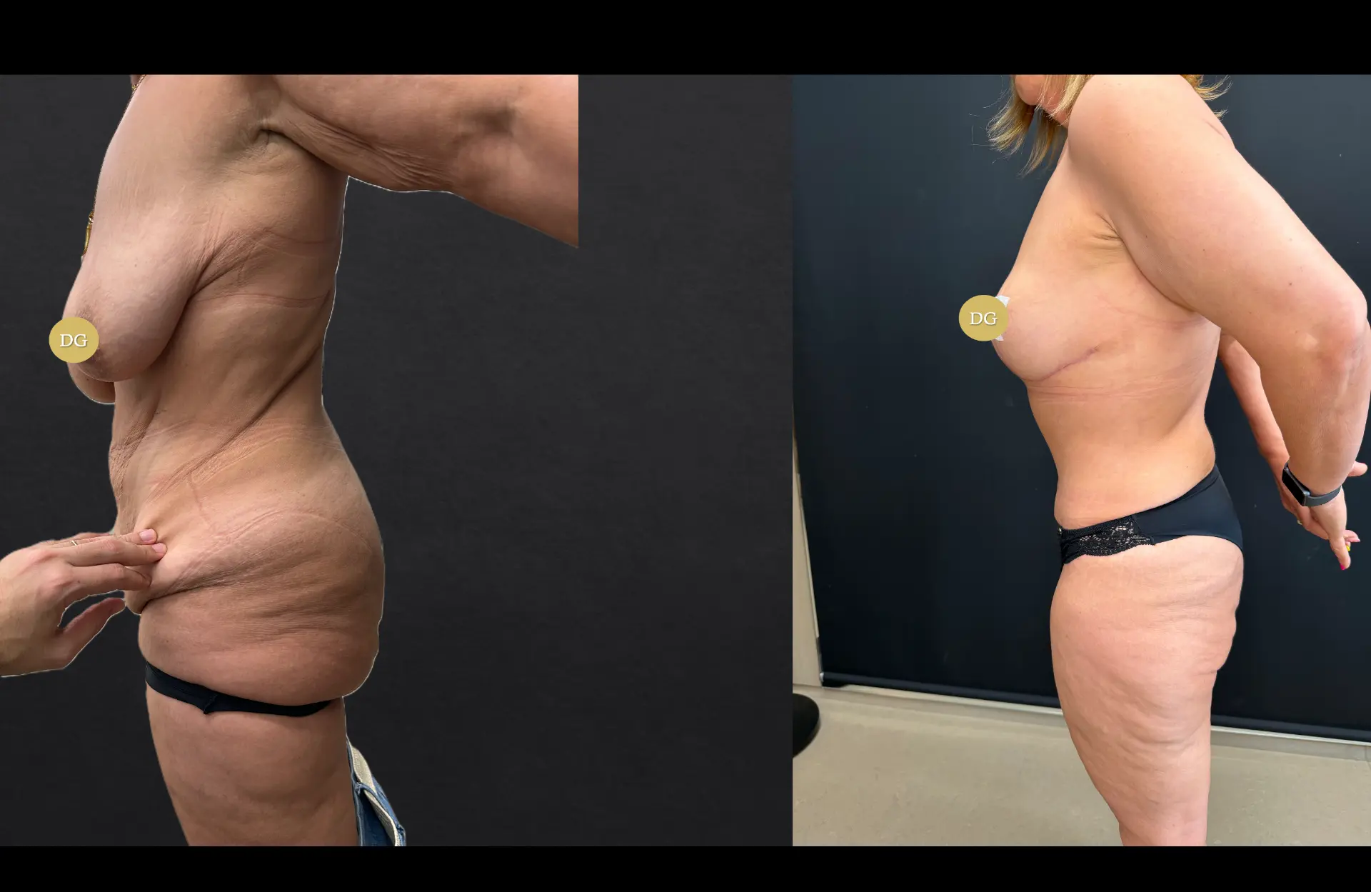 Caso 2 — Cirurgia combinada — Antes e depois — vista de perfil