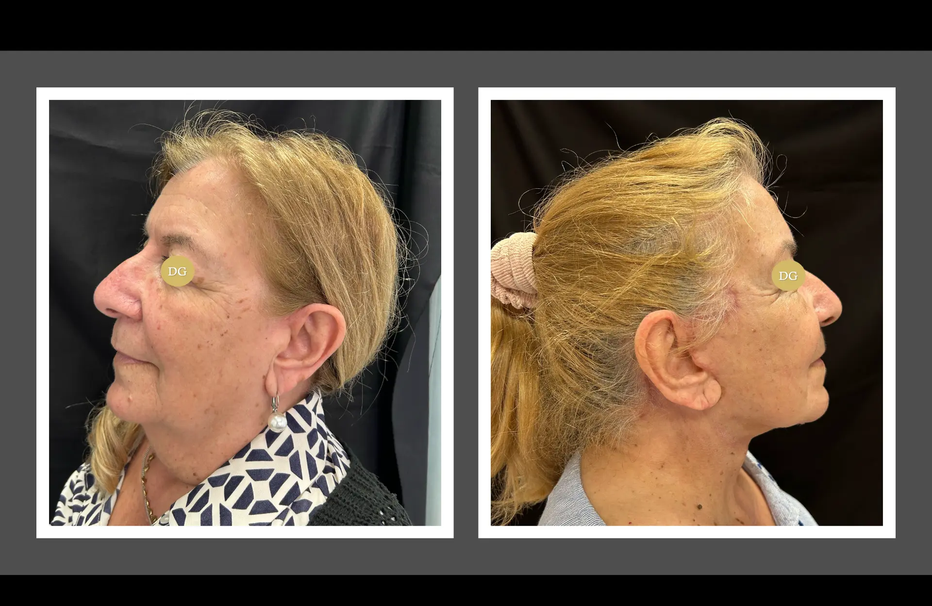 Caso 2 — Facelift cervico-facial — Antes e depois — vista oblíqua