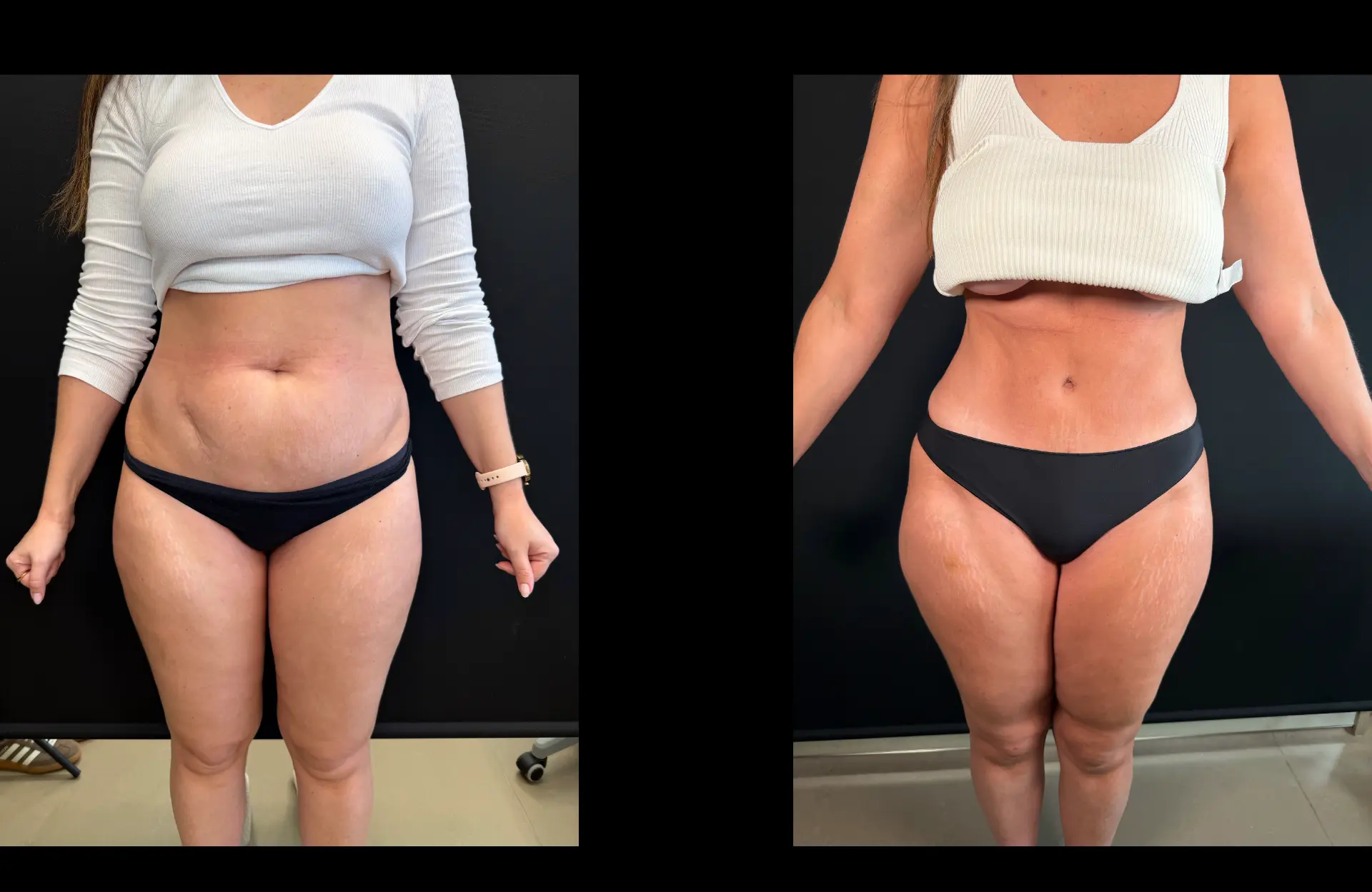 Caso 1 — Lipoabdominoplastia — Antes e depois — vista frontal