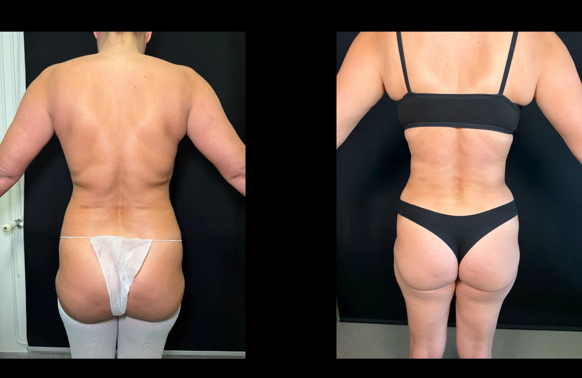 Caso 2 — Lipoabdominoplastia — Antes e depois — vista posterior