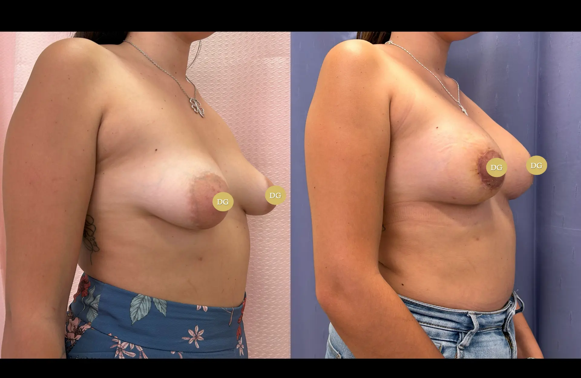 Caso 1 — Mama tuberosa — Antes e depois — vista oblíqua