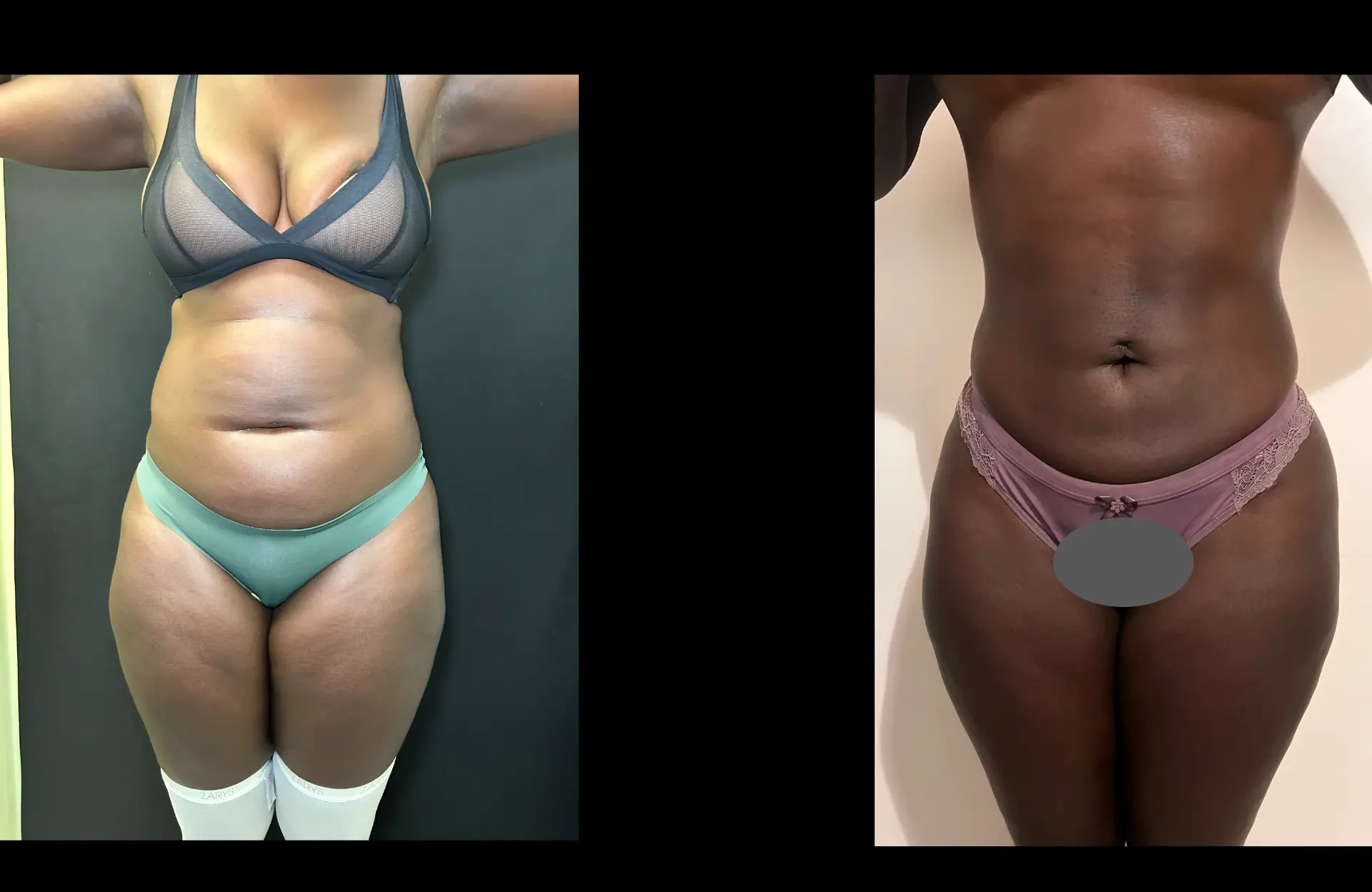 Caso 1 — Lipoescultura — Antes e depois — vista frontal