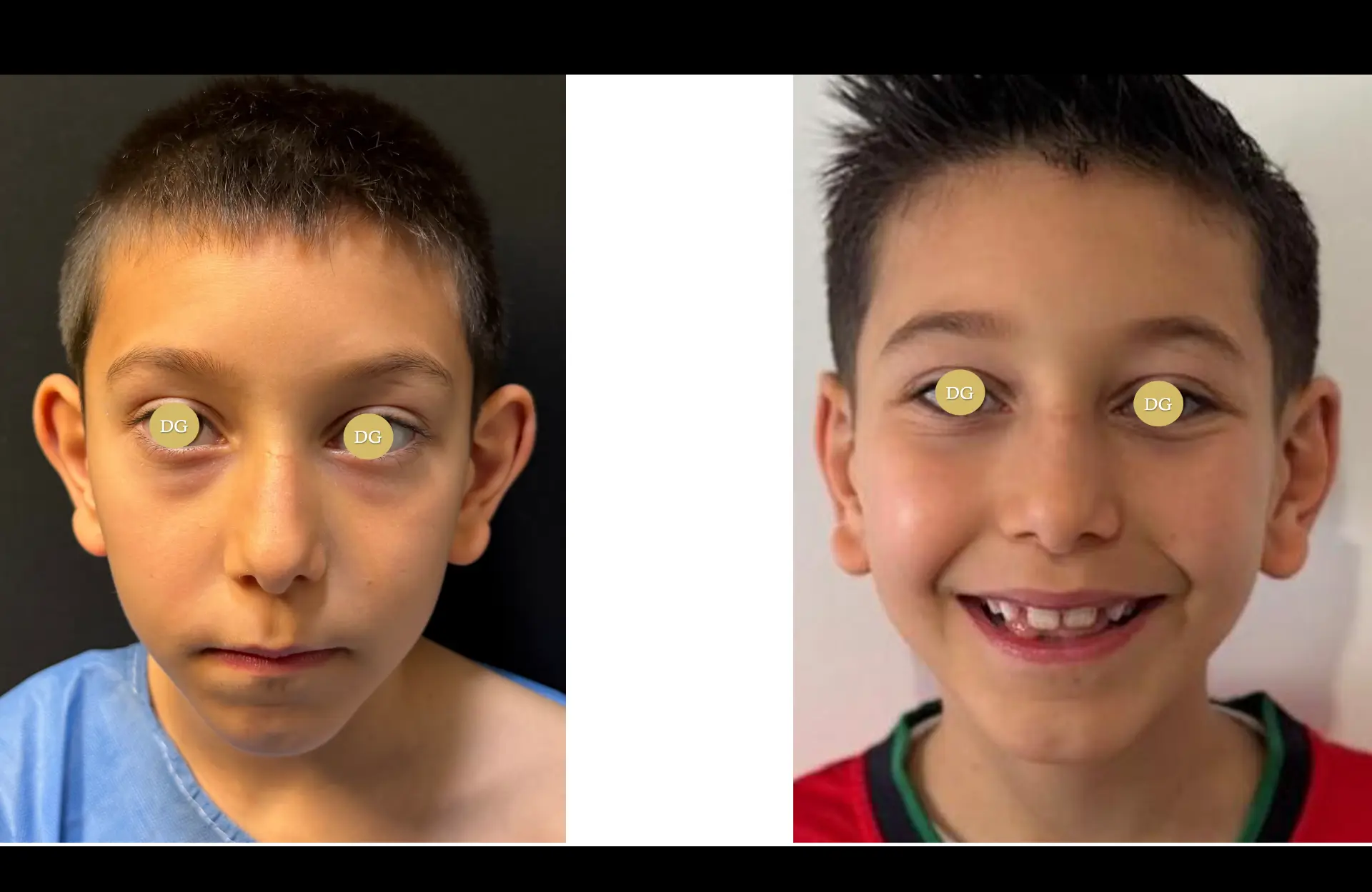 Caso 1 — Otoplastia — Antes e depois — vista frontal