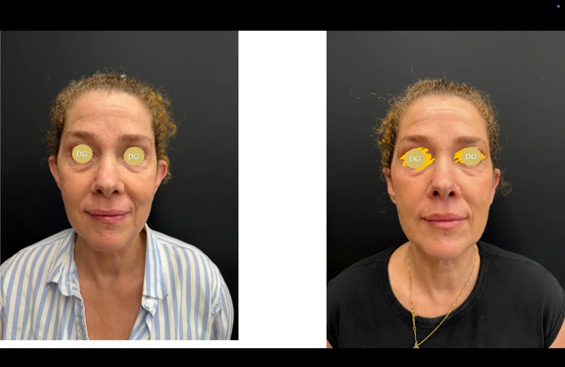 Caso 2 — Otoplastia — Antes e depois — vista frontal