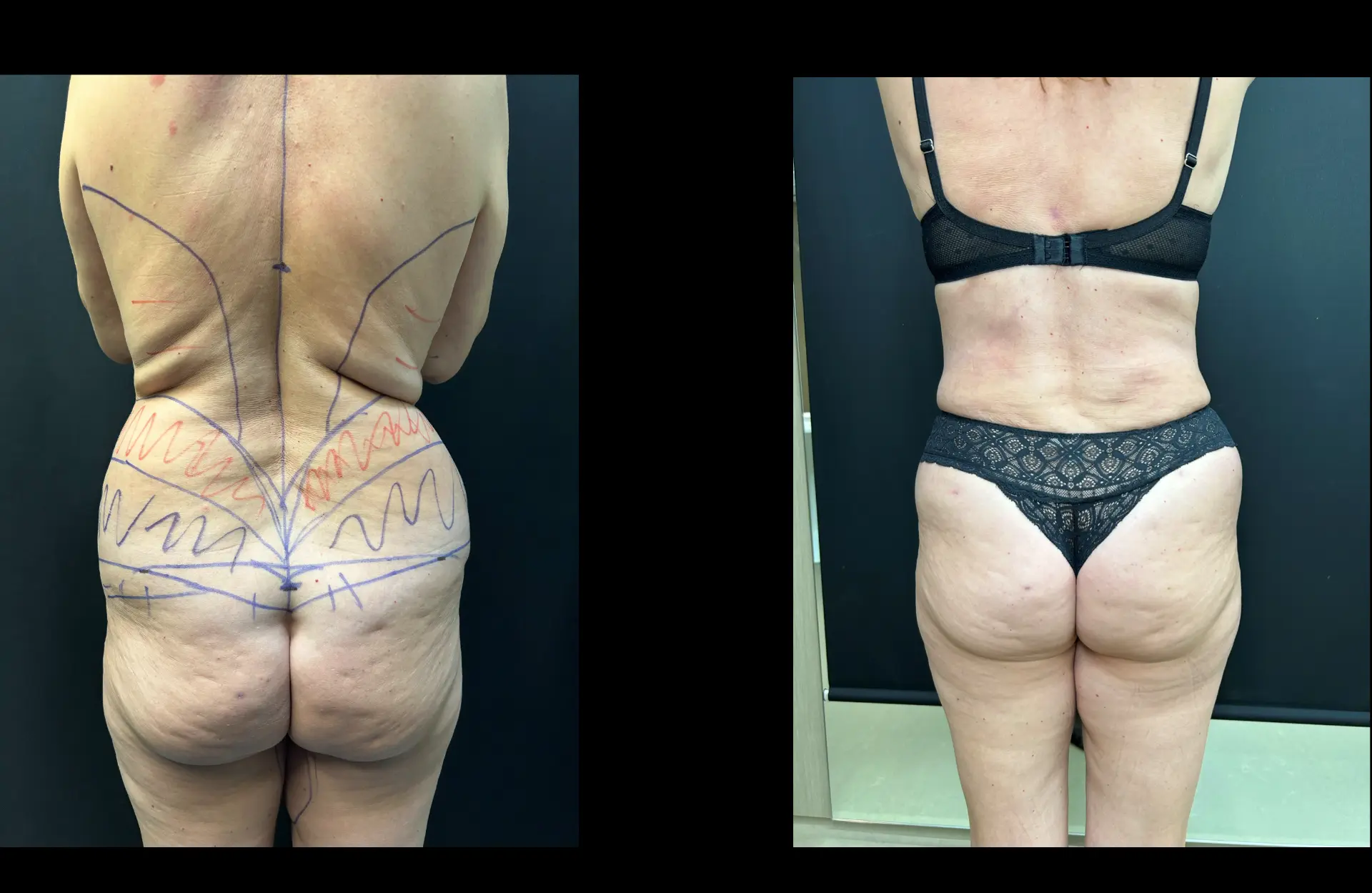Caso 4 — Lipoabdominoplastia — Antes e depois — vista posterior