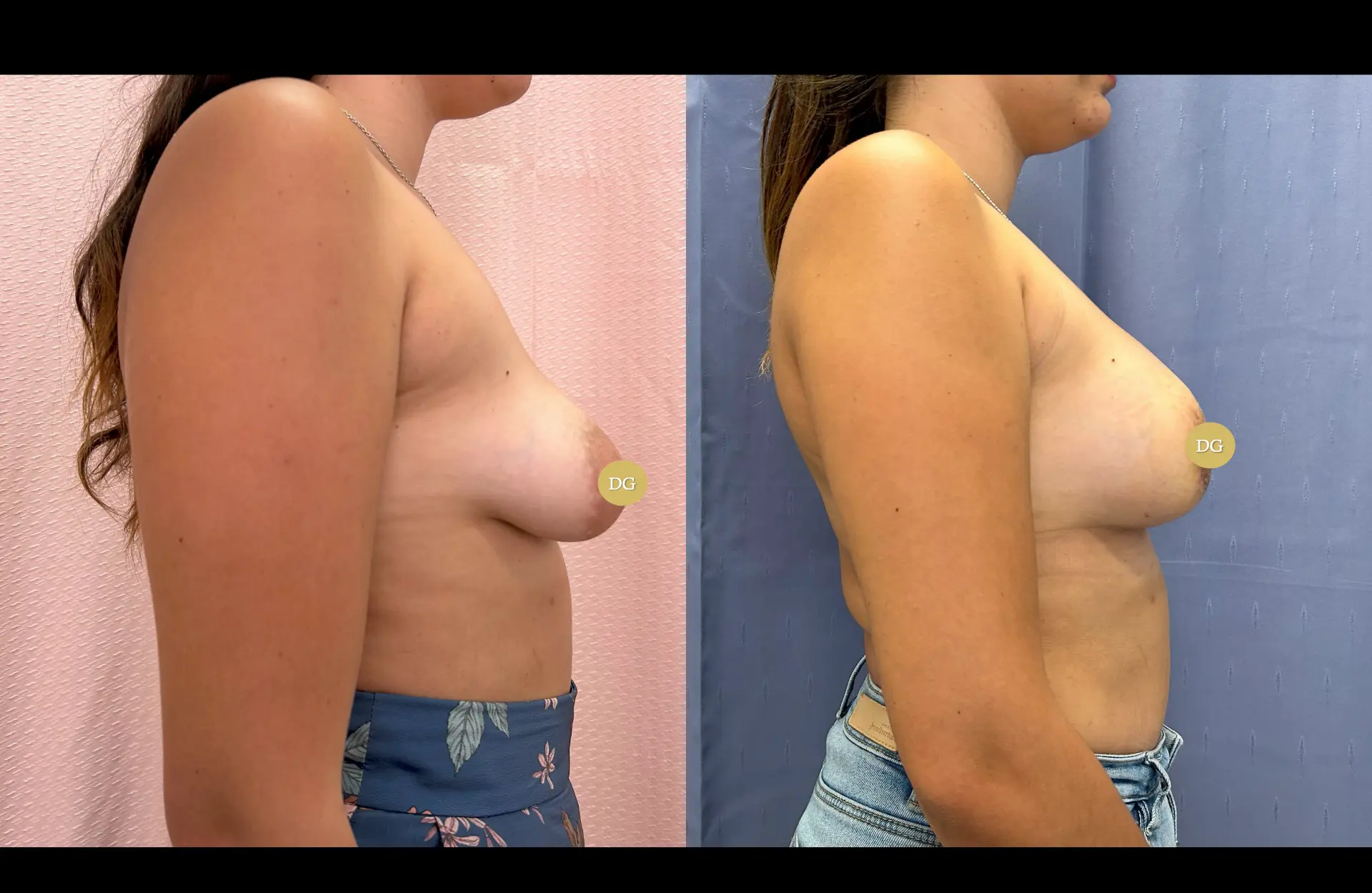 Caso 1 — Mama tuberosa — Antes e depois — vista de perfil