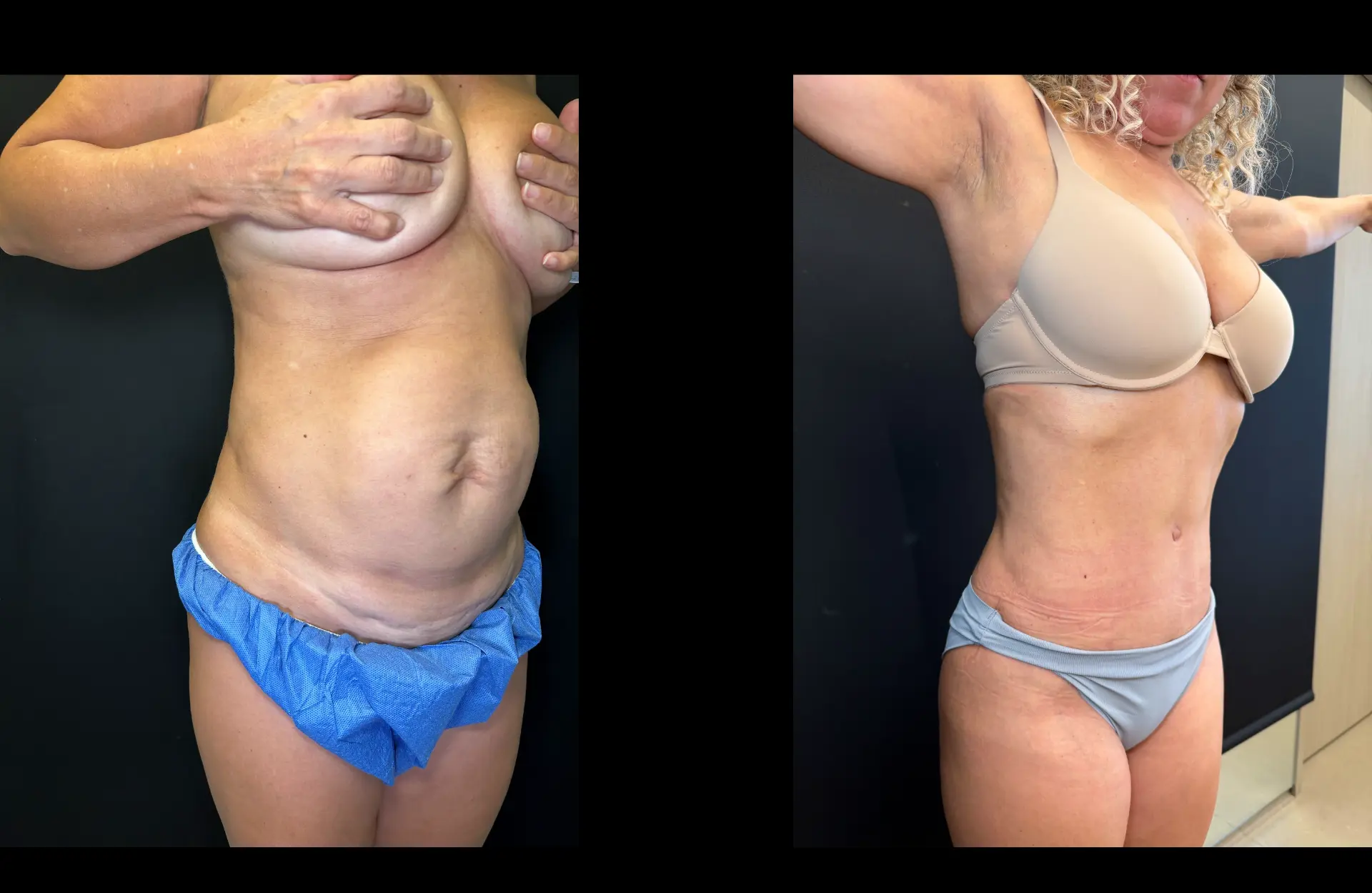 Caso 5 — Lipoabdominoplastia — Antes e depois — vista oblíqua