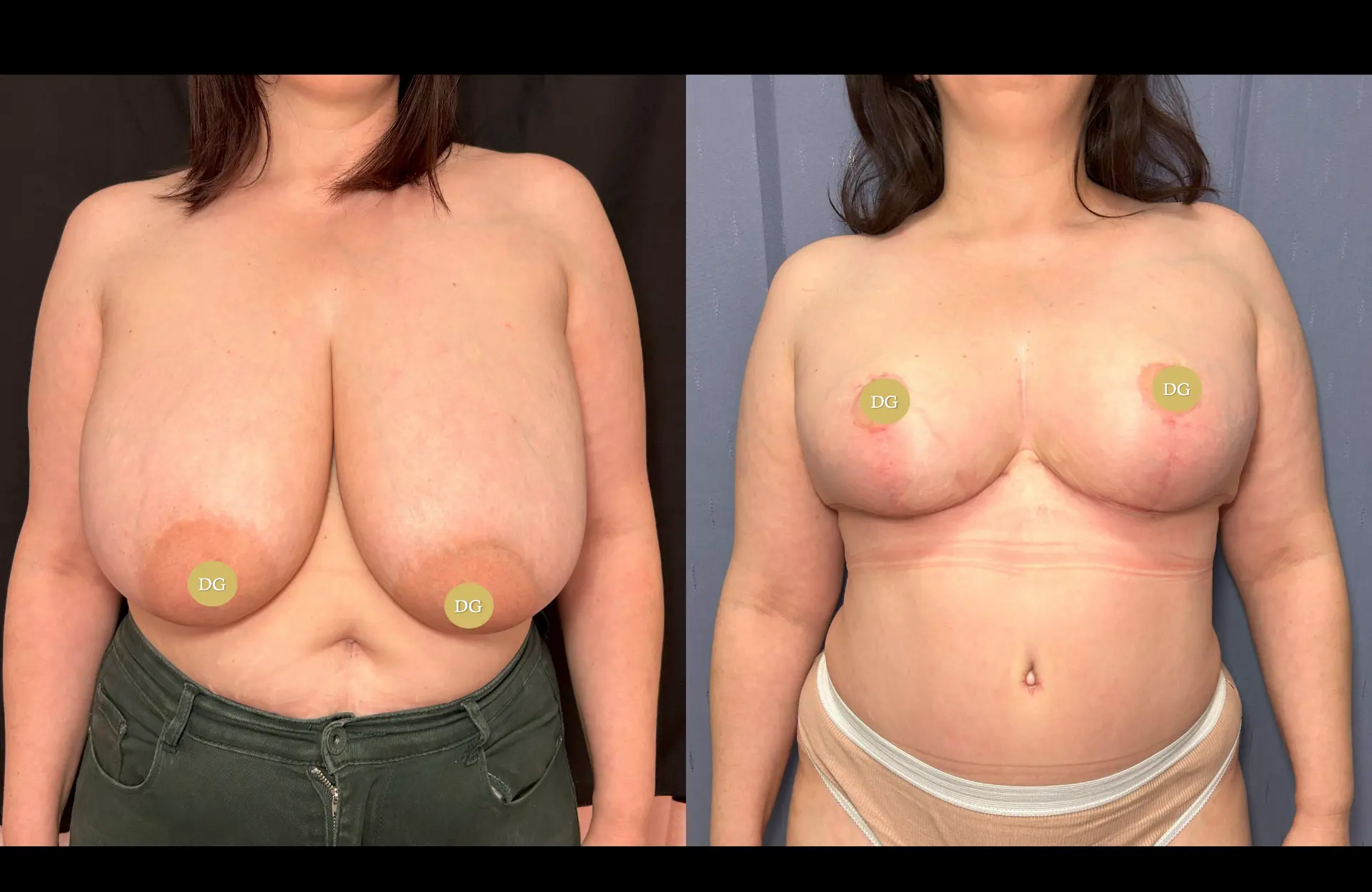 Caso 2 — Mamoplastia de redução — Antes e depois — vista frontal