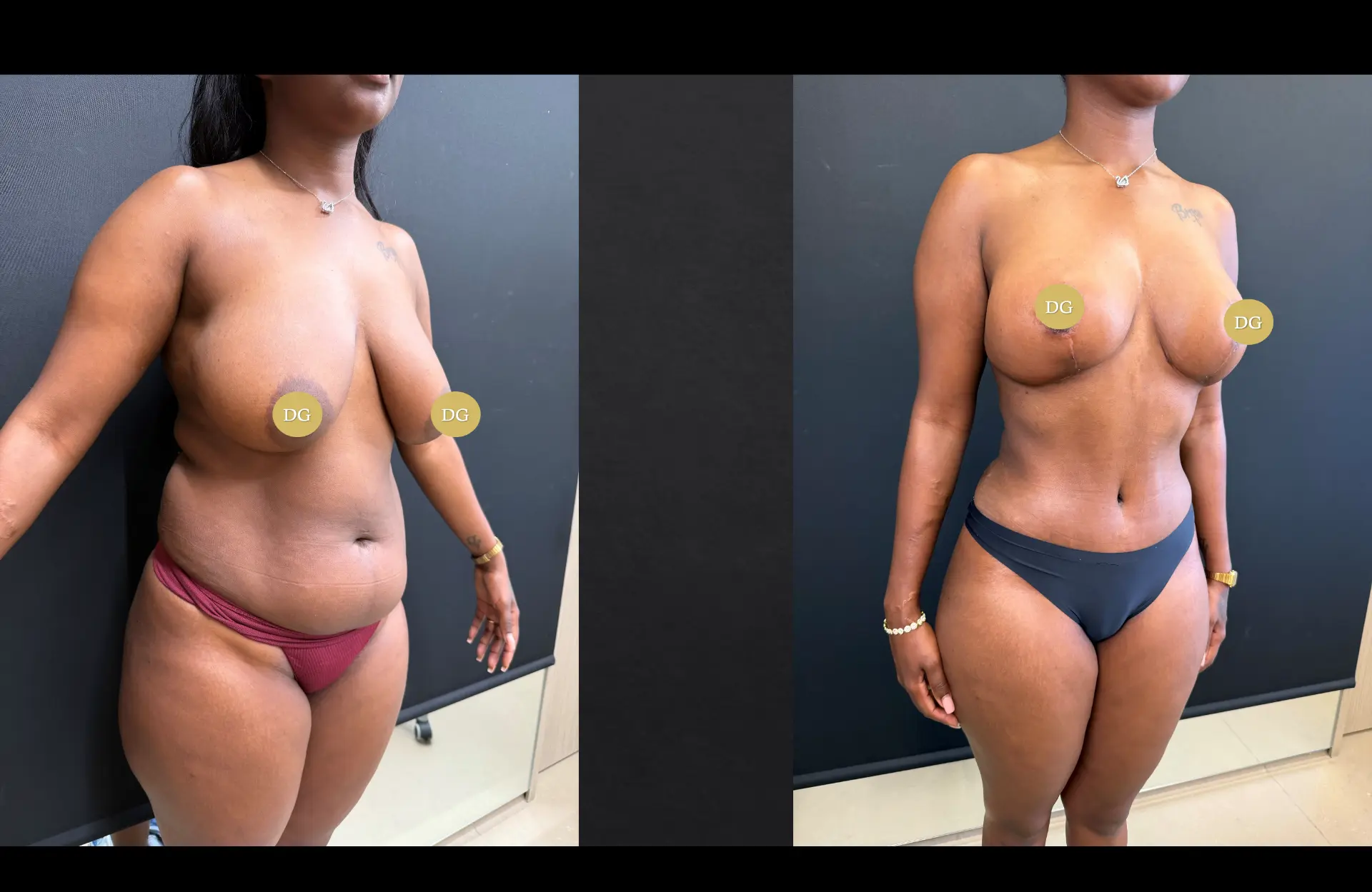 Caso 1 — Cirurgia combinada — Antes e depois — vista oblíqua