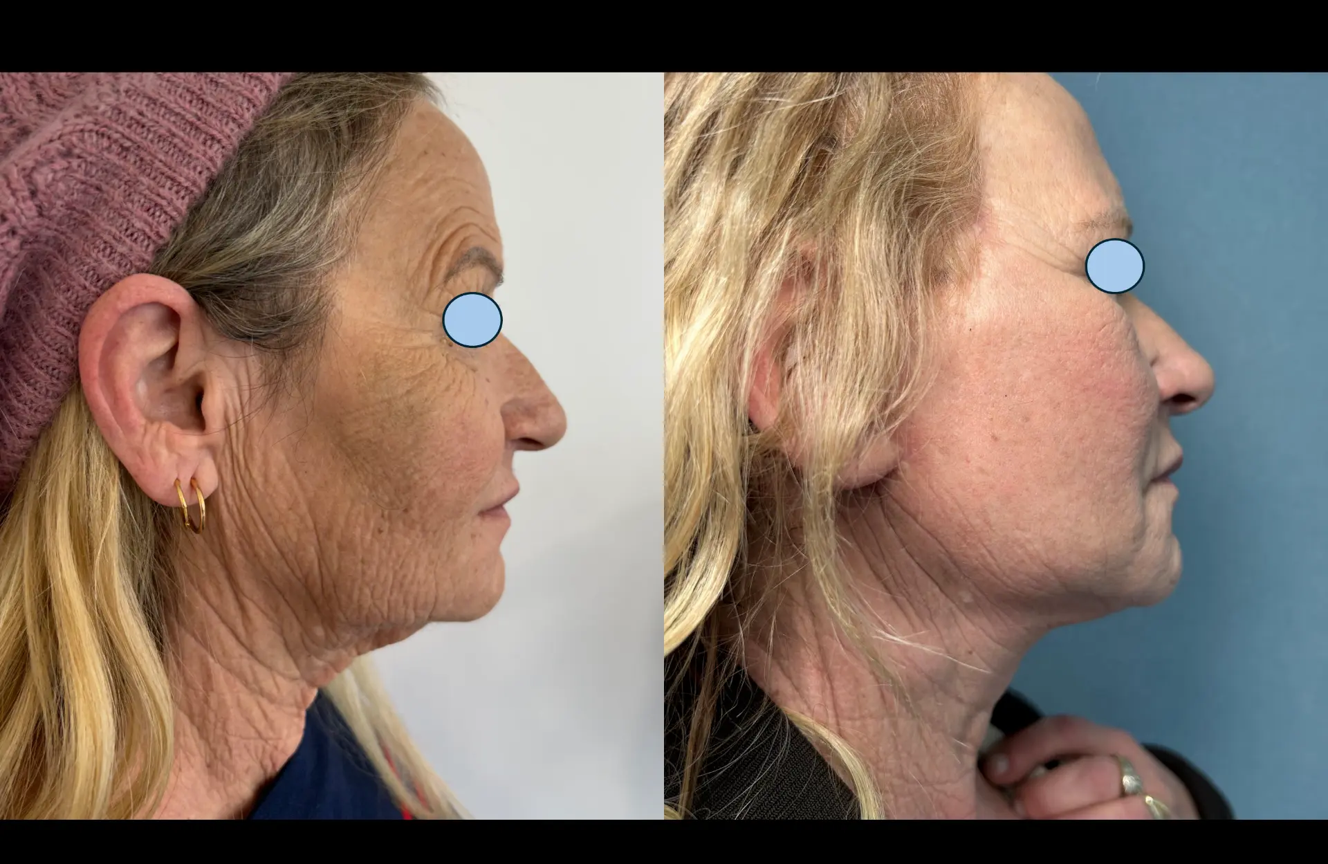Caso 1 — Facelift cervico-facial — Antes e depois — vista de perfil