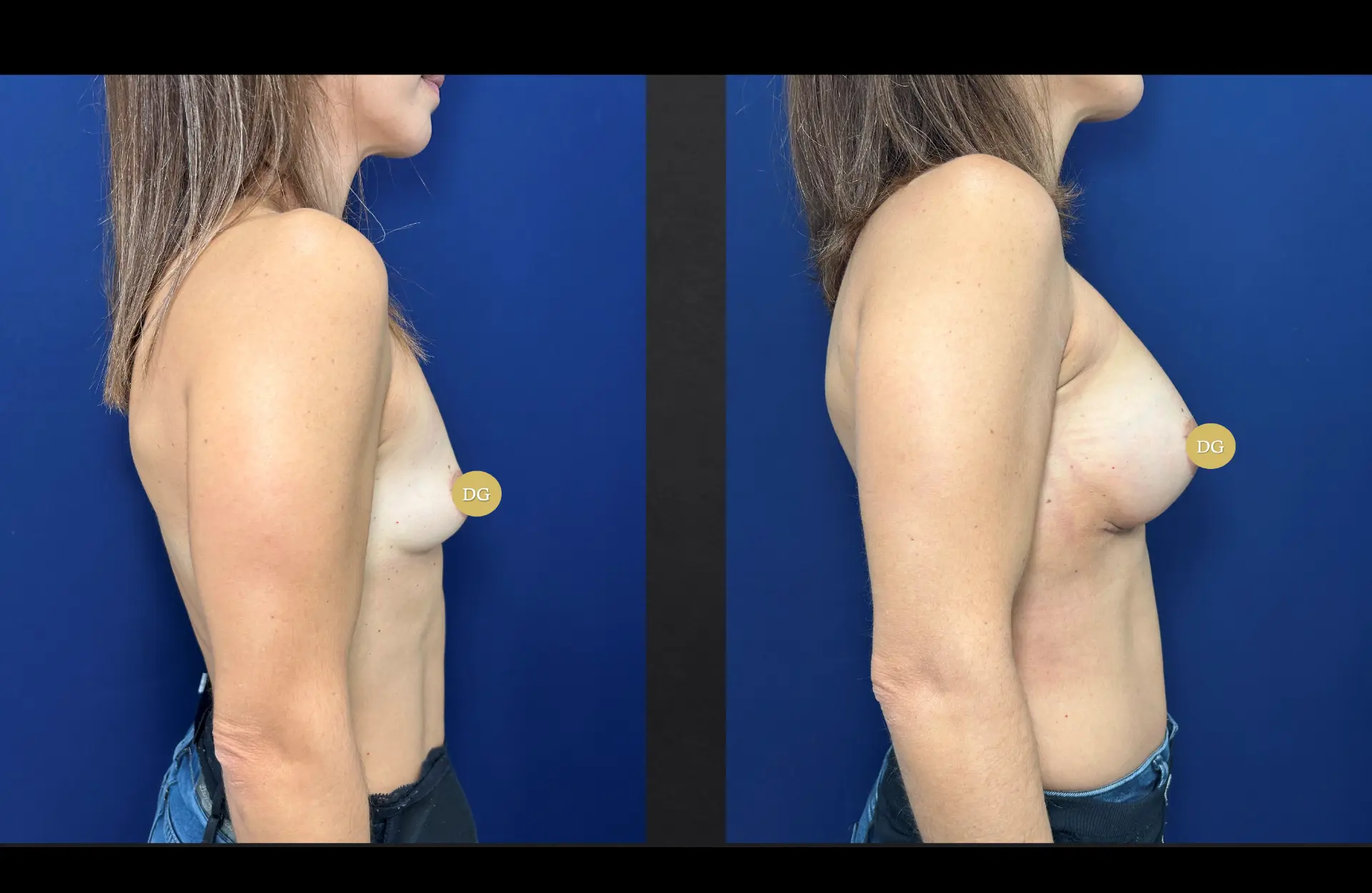 Caso 4 — Mamoplastia de aumento — Antes e depois — vista de perfil