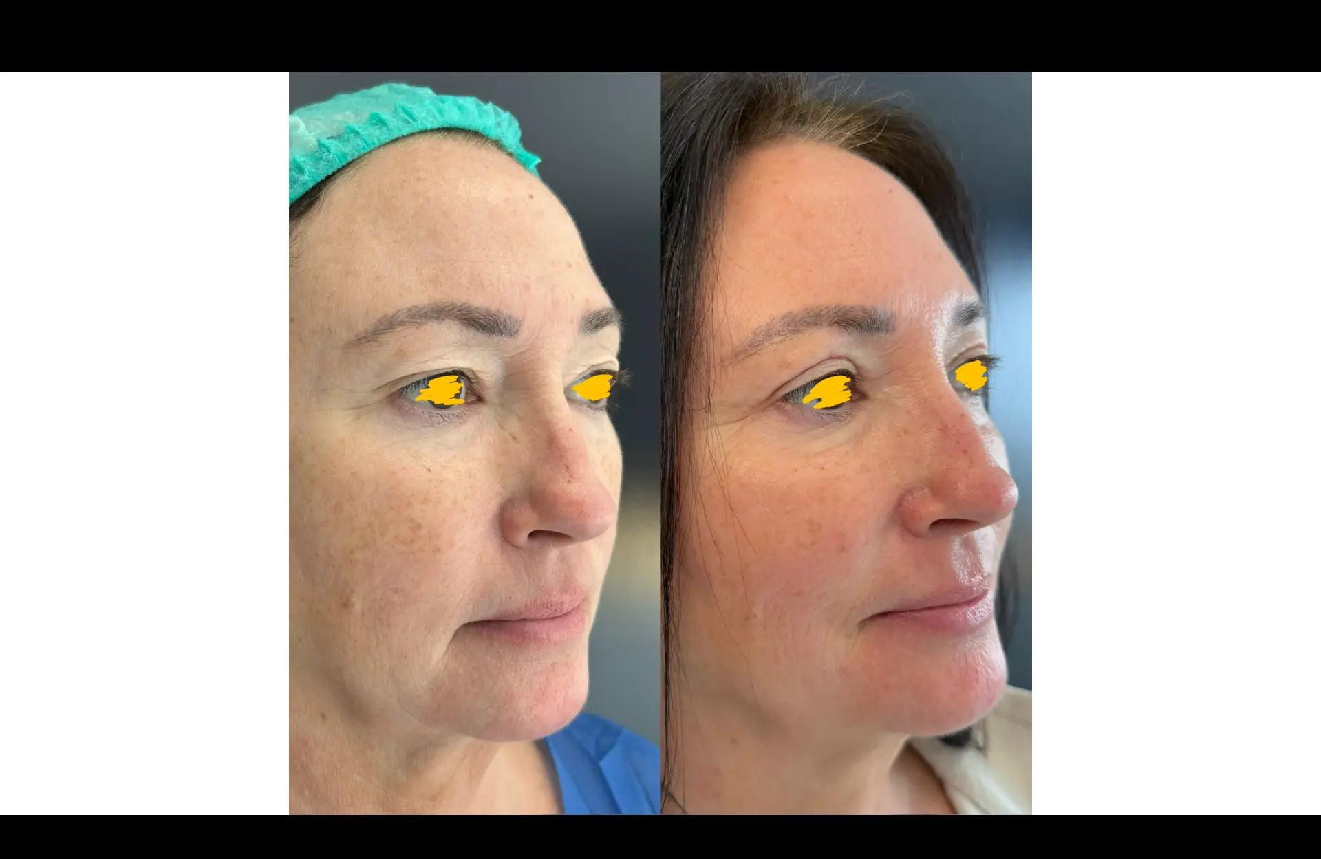 Caso 1 — Blefaroplastia — Antes e depois — vista oblíqua