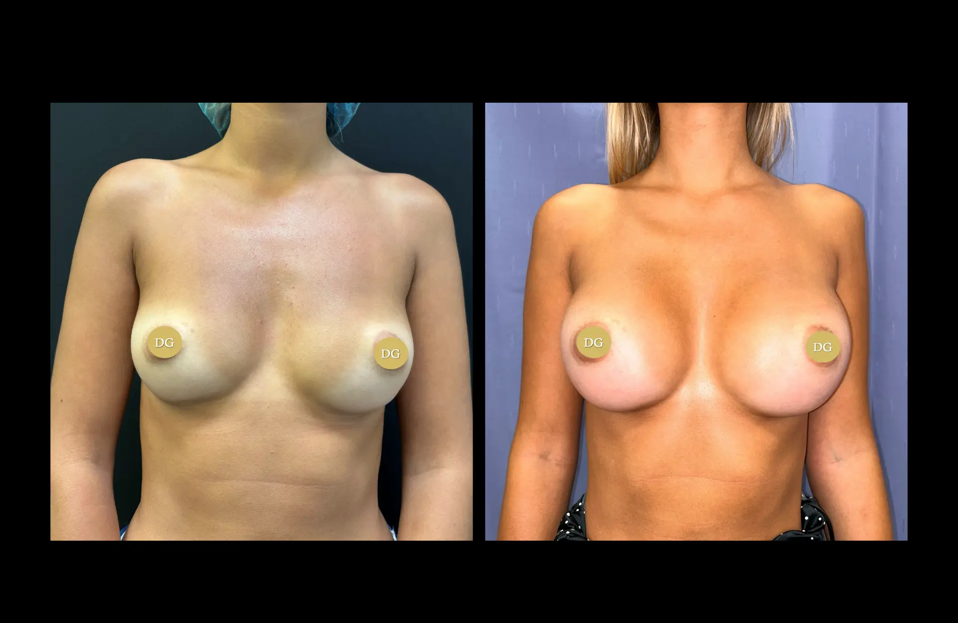 Caso 1 — Mamoplastia de aumento — Antes e depois — vista frontal