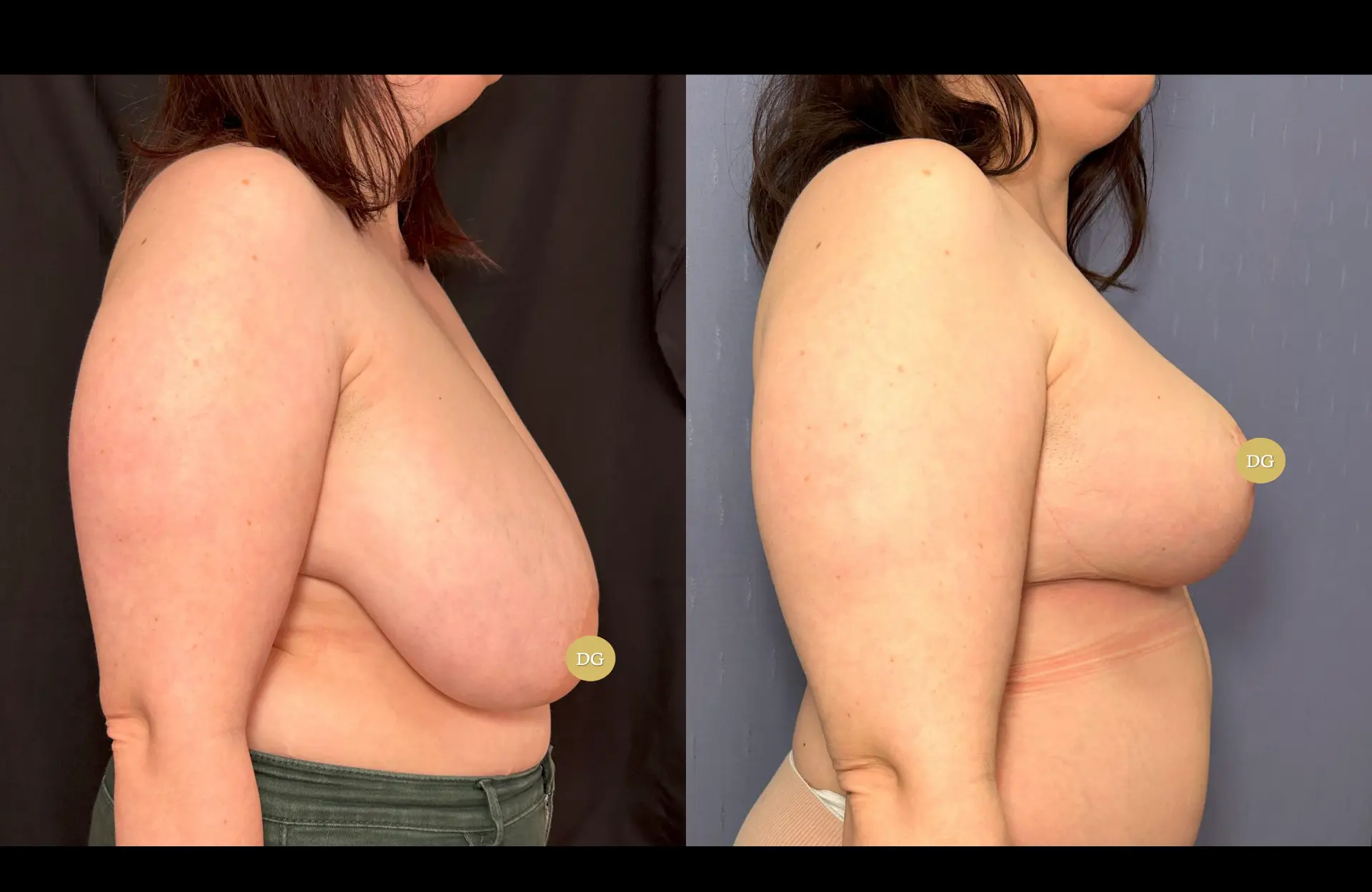 Caso 2 — Mamoplastia de redução — Antes e depois — vista de perfil