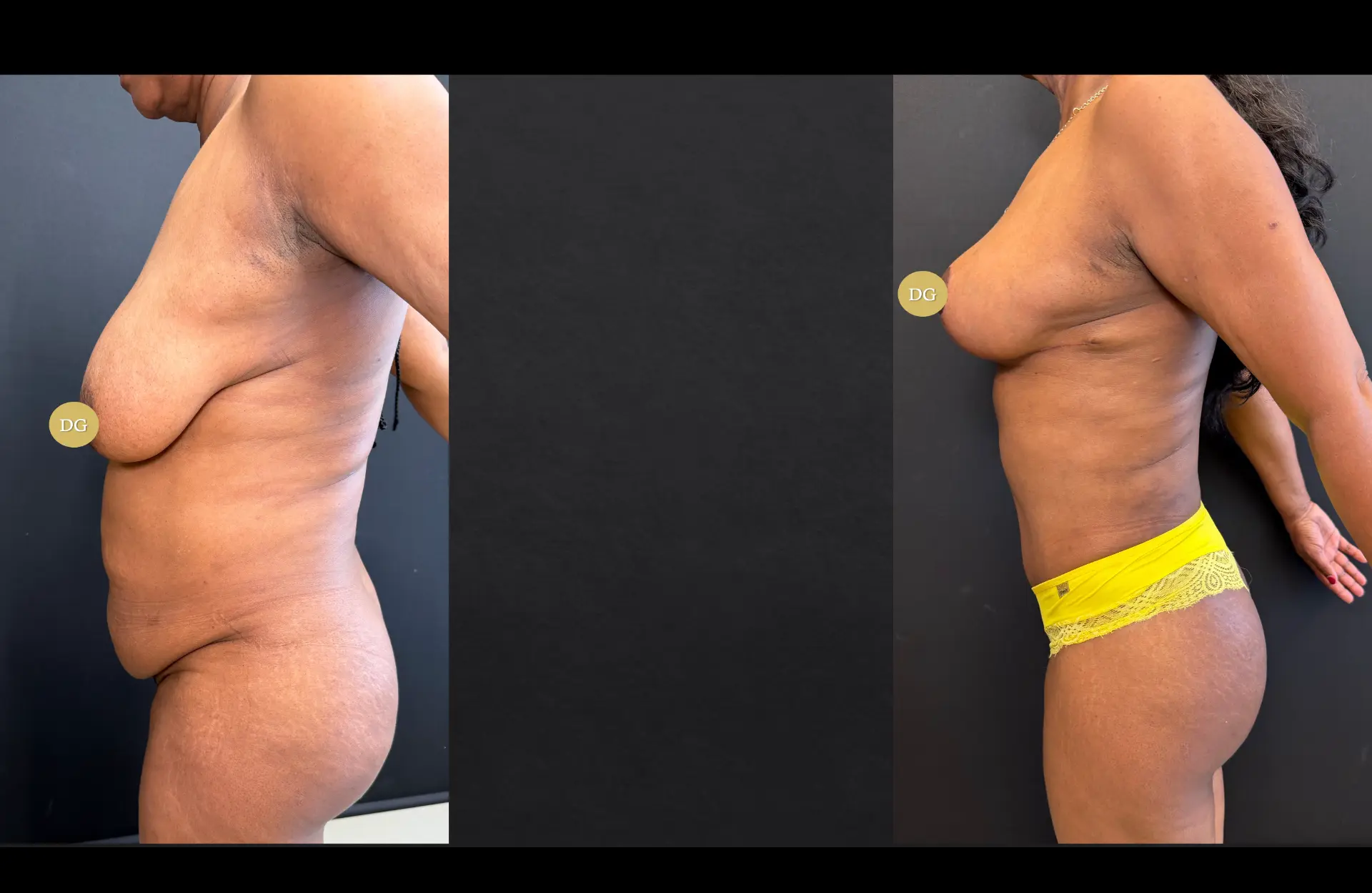 Caso 3 — Cirurgia combinada — Antes e depois — vista de perfil