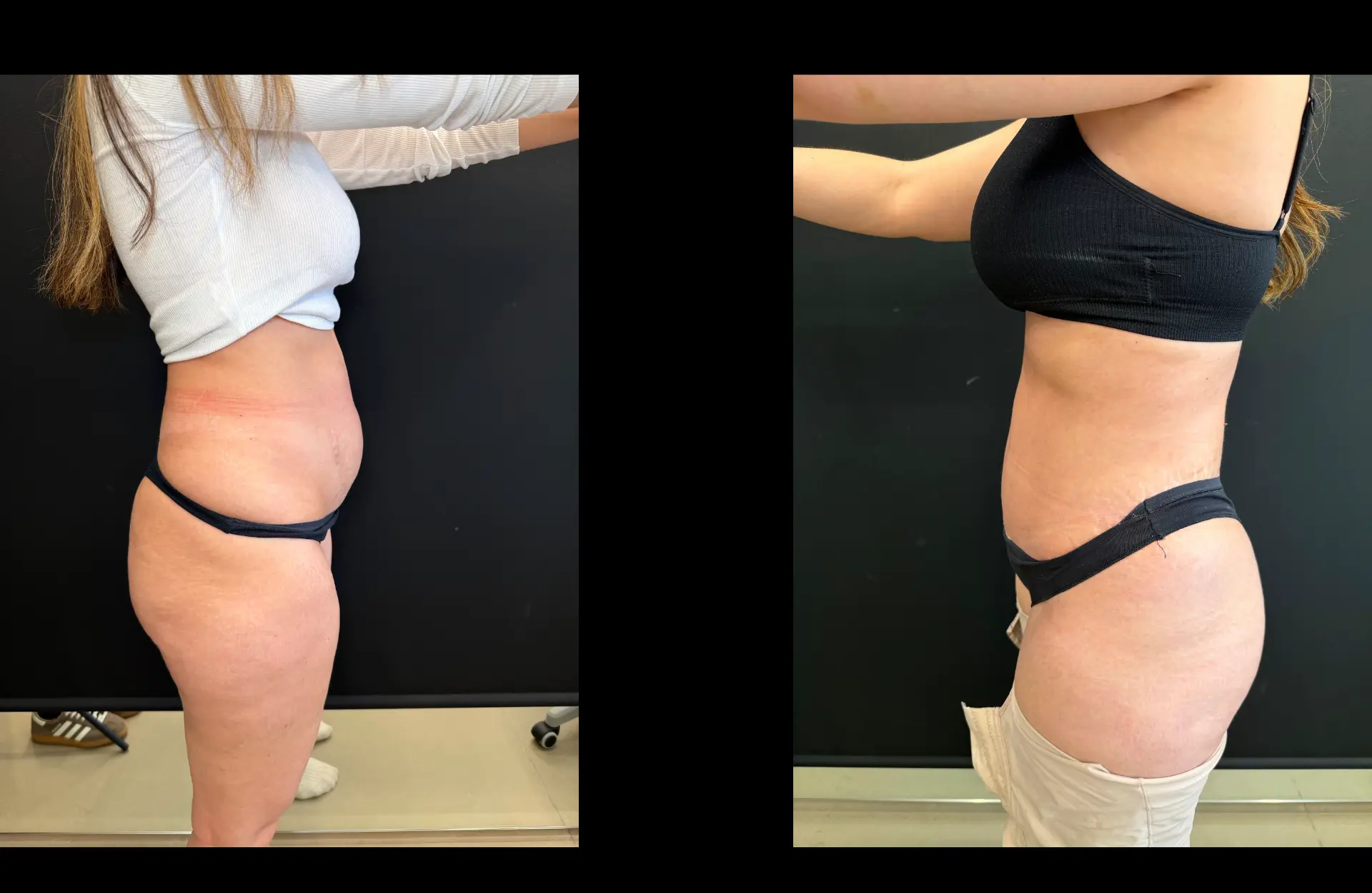 Caso 1 — Lipoabdominoplastia — Antes e depois — vista de perfil