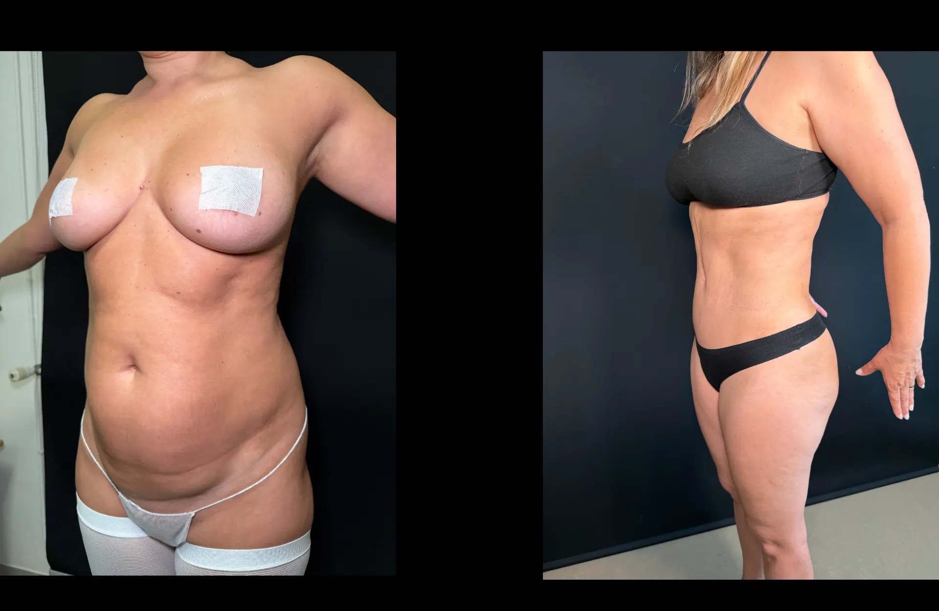 Caso 2 — Lipoabdominoplastia — Antes e depois — vista oblíqua contralateral