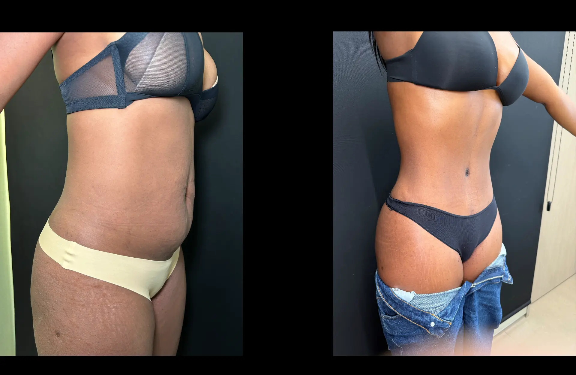 Caso 3 — Lipoabdominoplastia — Antes e depois — vista oblíqua