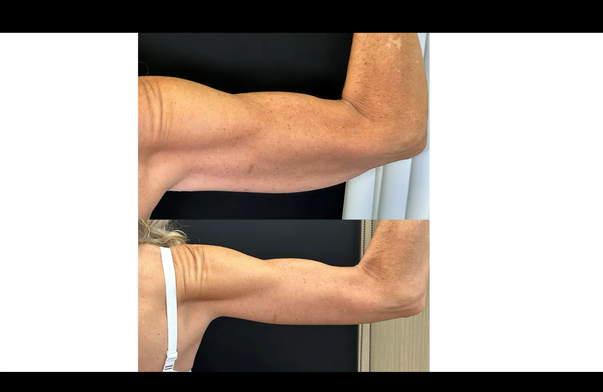Caso 1 — Braquioplastia — Antes e depois — vista de perfil