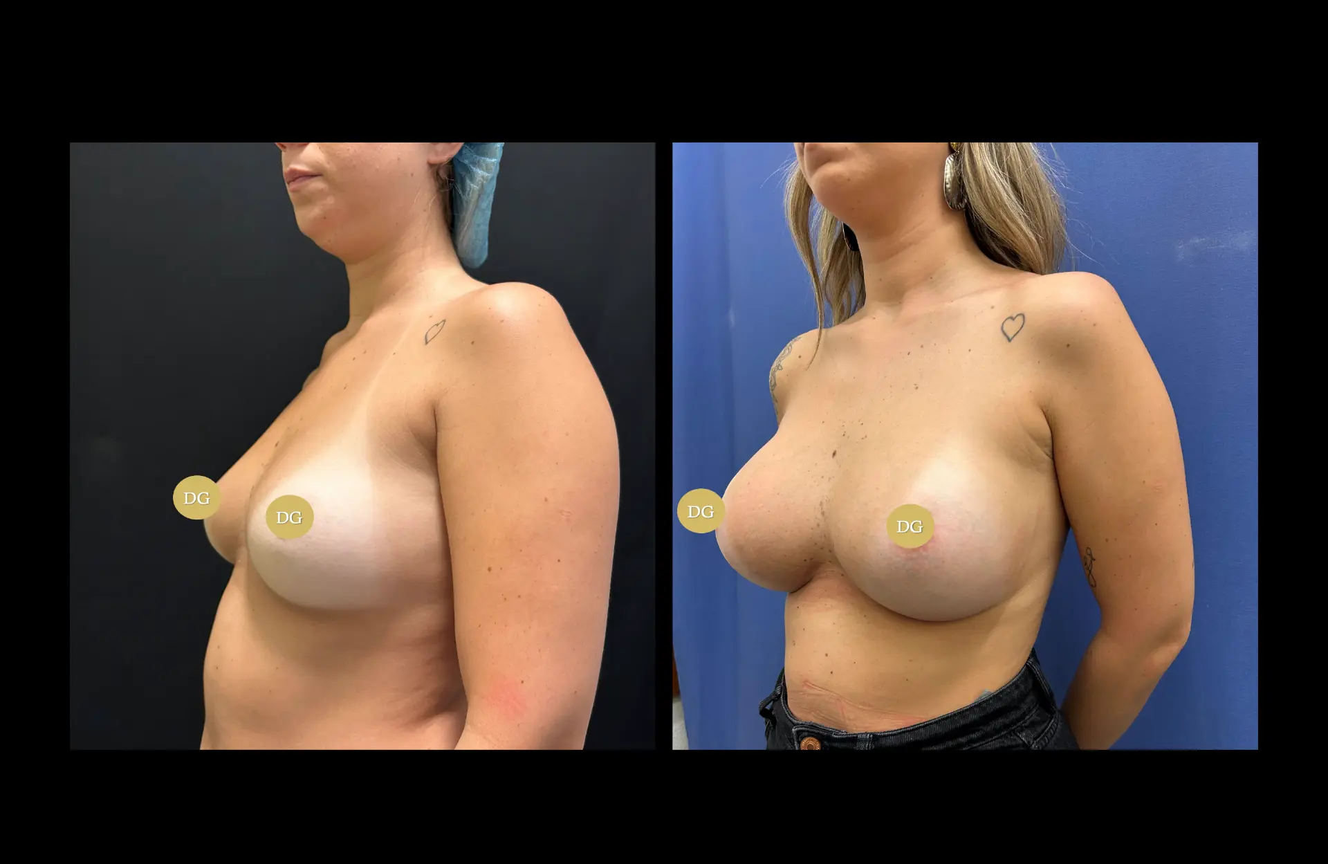 Caso 2 — Mamoplastia de aumento — Antes e depois — vista oblíqua