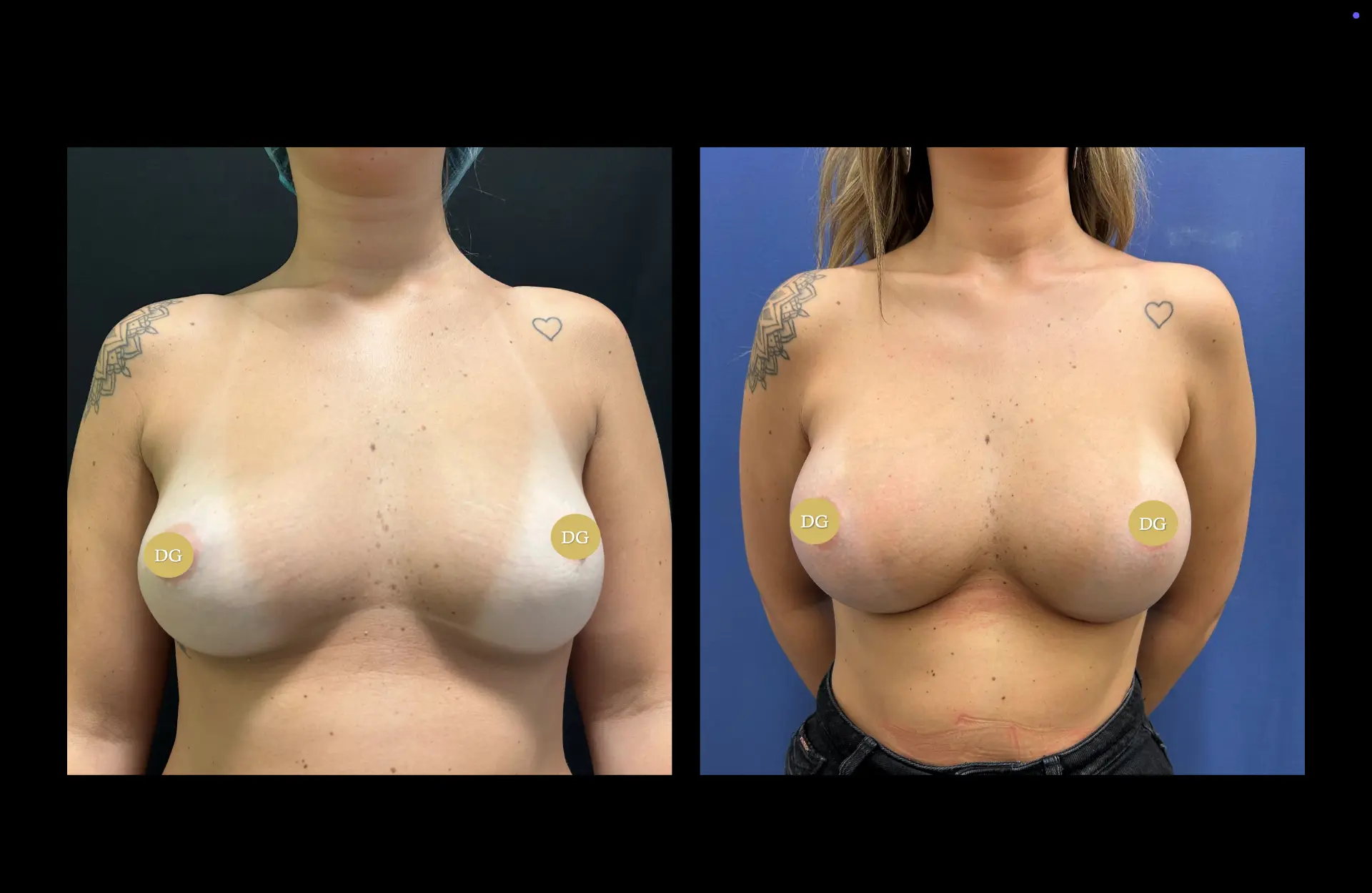 Caso 2 — Mamoplastia de aumento — Antes e depois — vista frontal