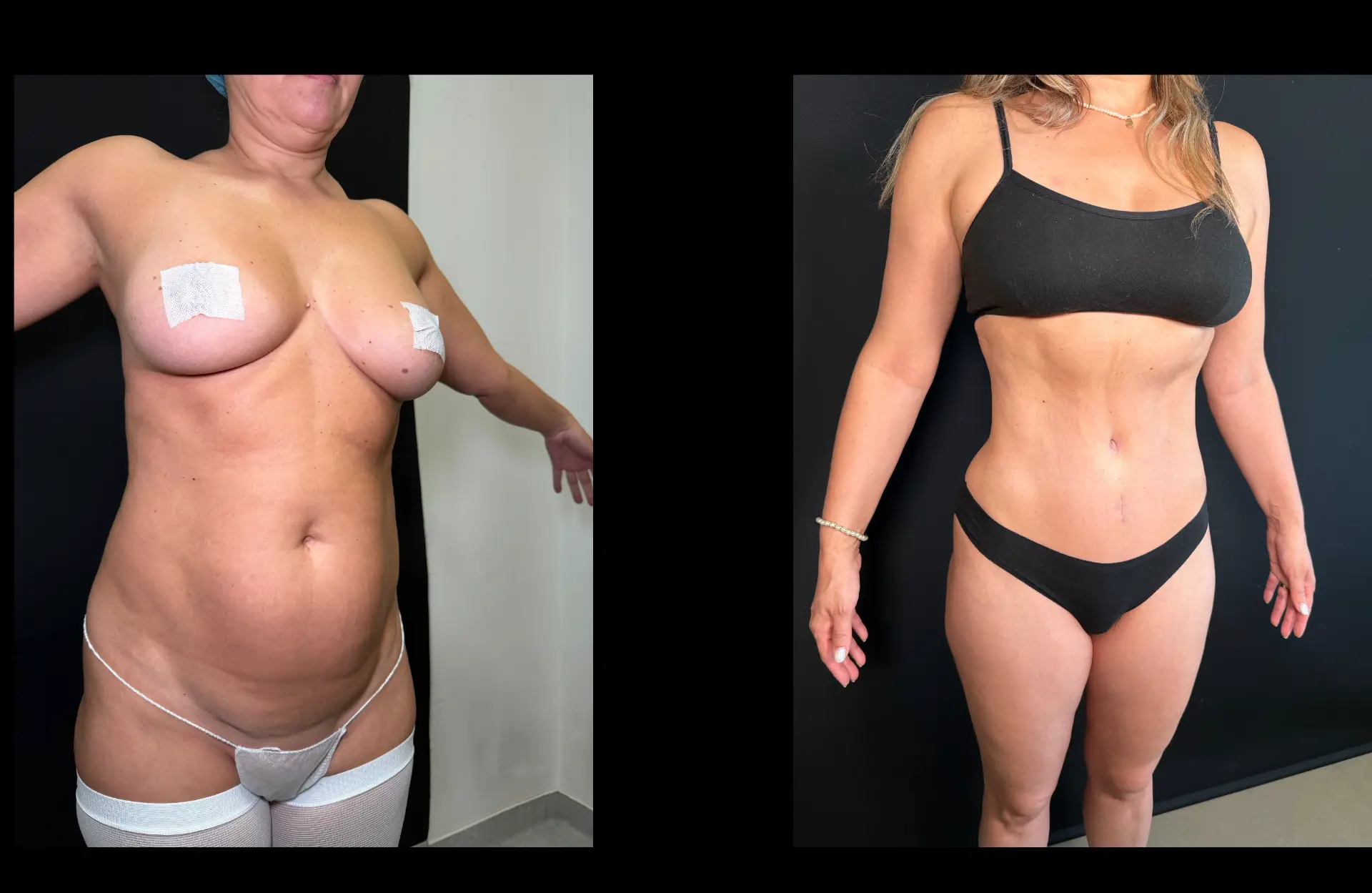 Caso 2 — Lipoabdominoplastia — Antes e depois — vista oblíqua