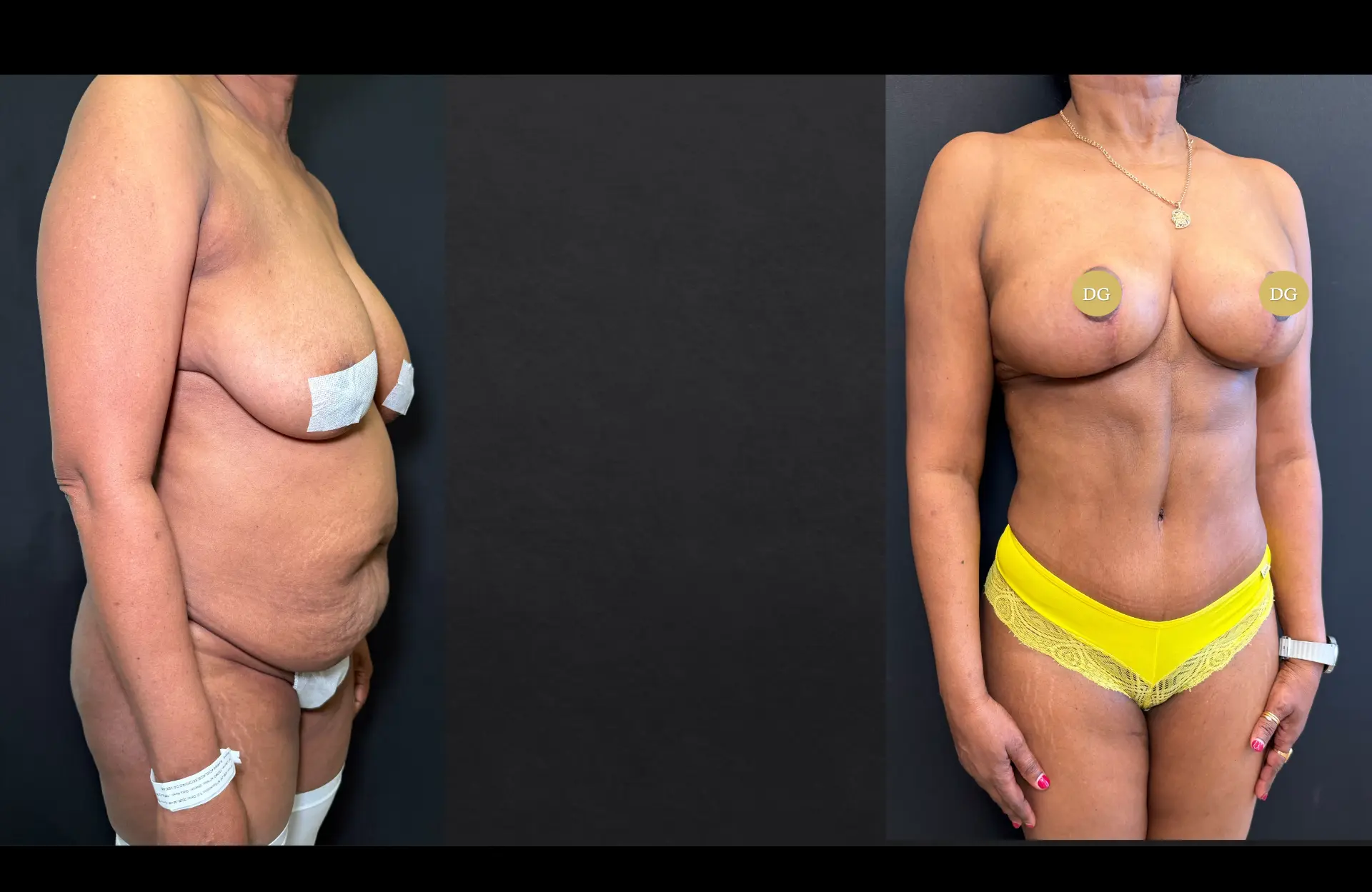 Caso 3 — Cirurgia combinada — Antes e depois — vista oblíqua