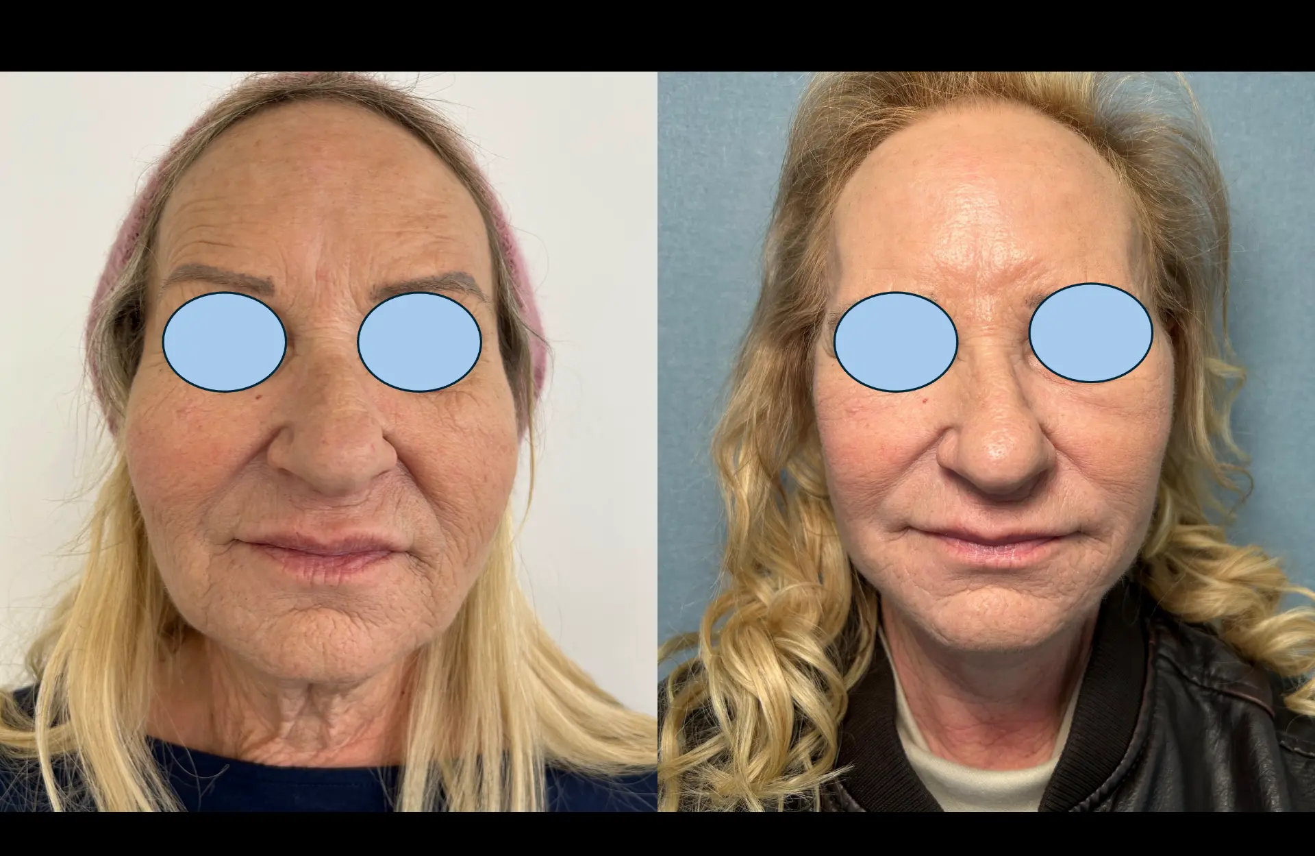 Caso 1 — Facelift cervico-facial — Antes e depois — vista frontal