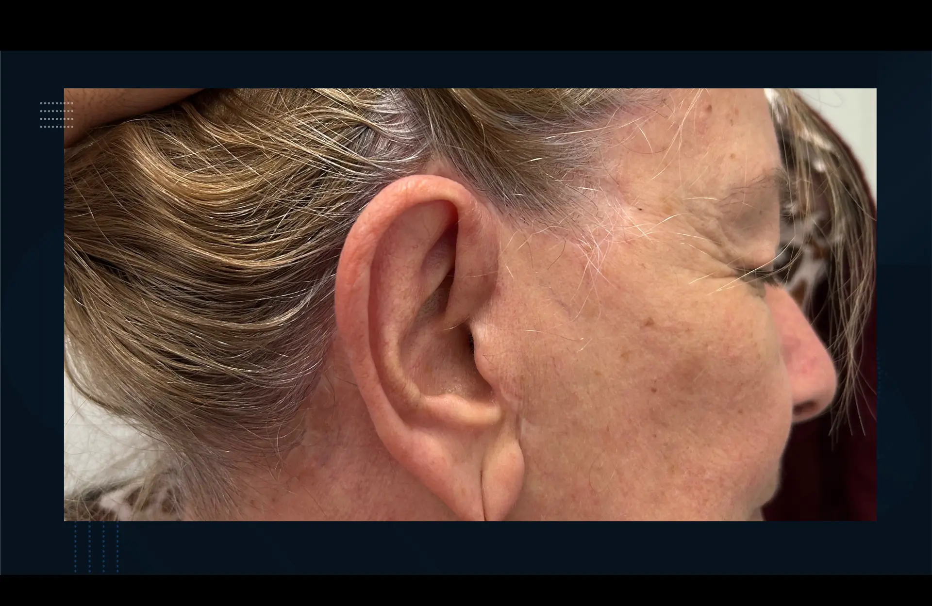 Caso 2 — Facelift cervico-facial — Qualidade da cicatriz aos 9 meses de pós-operatório