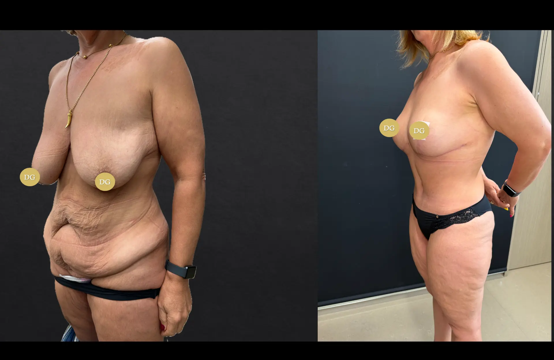 Caso 2 — Cirurgia combinada — Antes e depois — vista oblíqua
