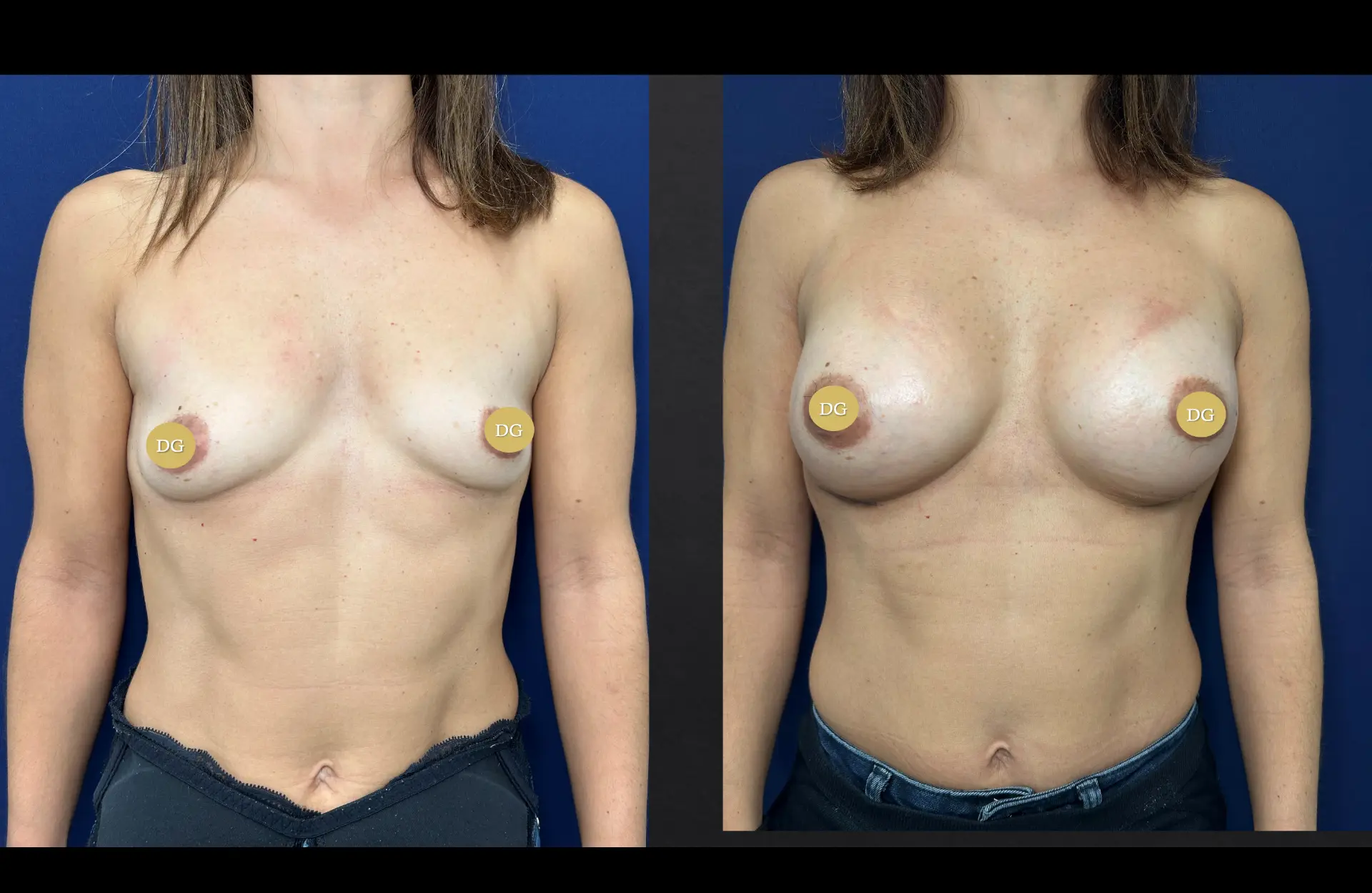 Caso 4 — Mamoplastia de aumento — Antes e depois — vista frontal