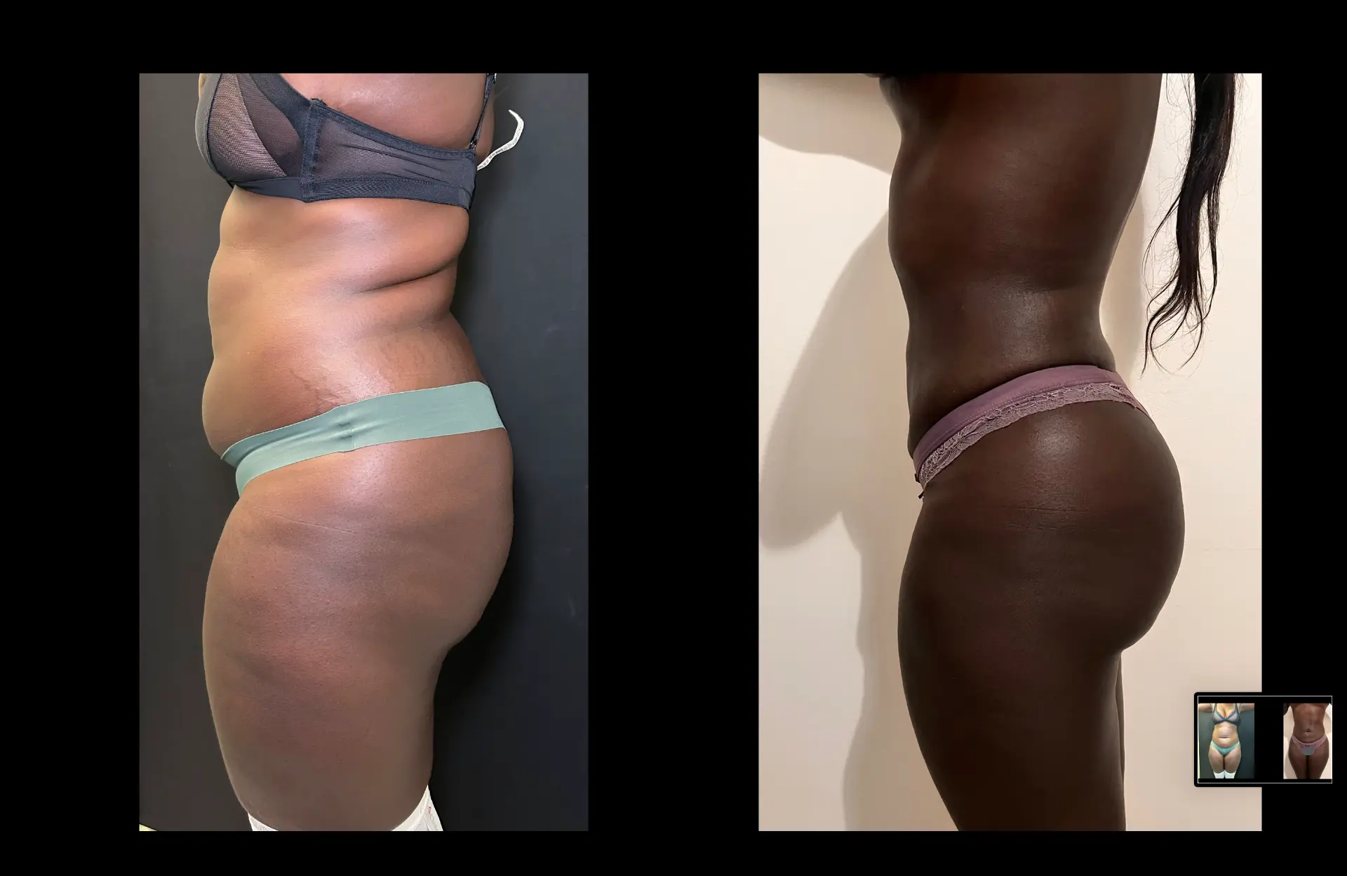 Caso 1 — Lipoescultura — Antes e depois — vista de perfil