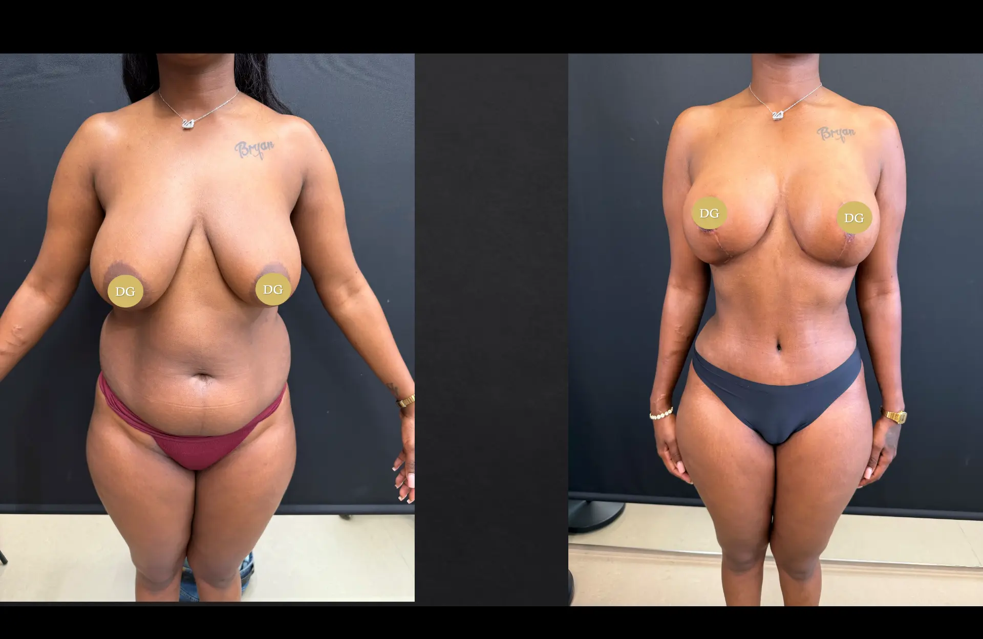 Caso 1 — Cirurgia combinada — Antes e depois — vista frontal
