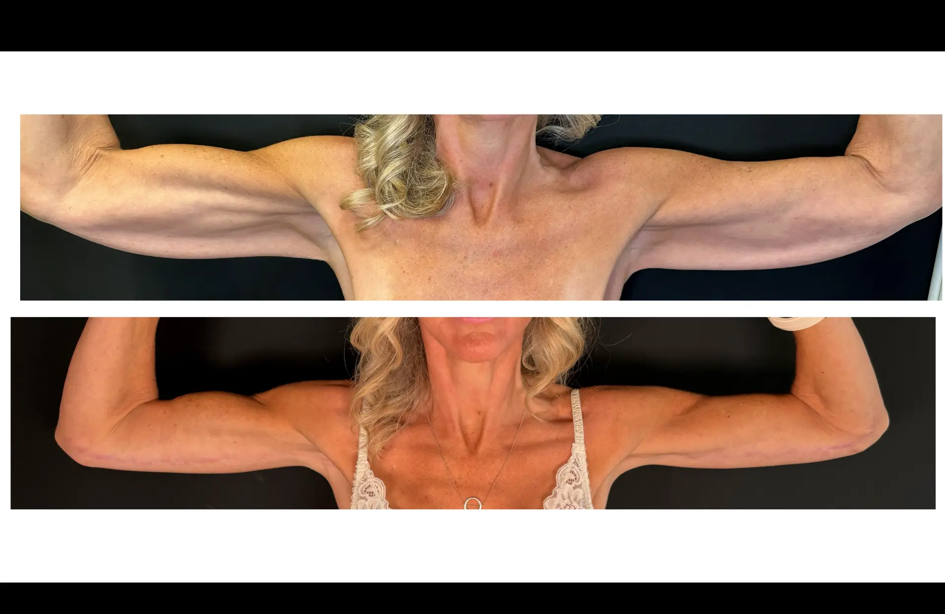 Caso 1 — Braquioplastia — Antes e depois — vista frontal