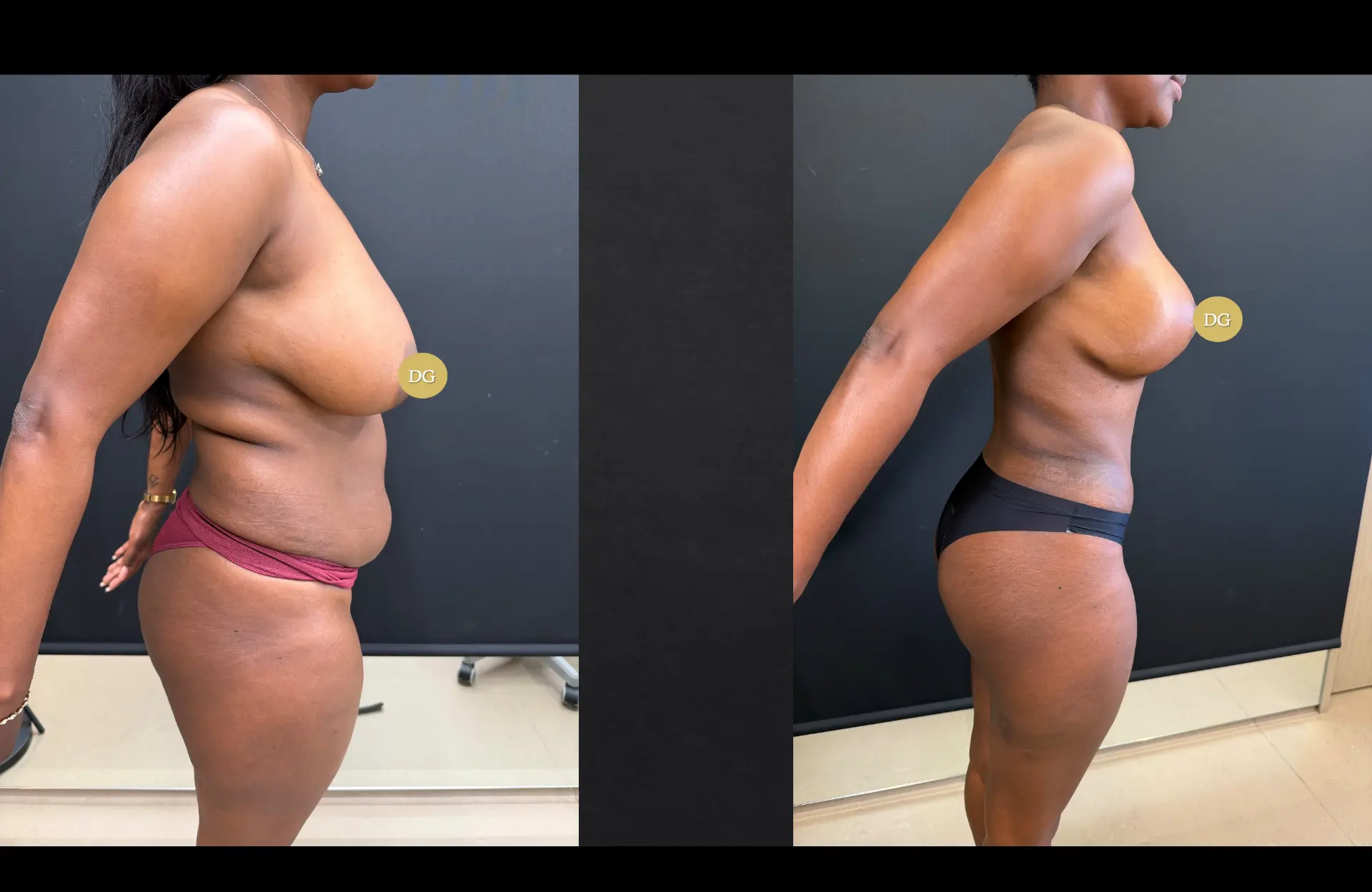 Caso 1 — Cirurgia combinada — Antes e depois — vista de perfil