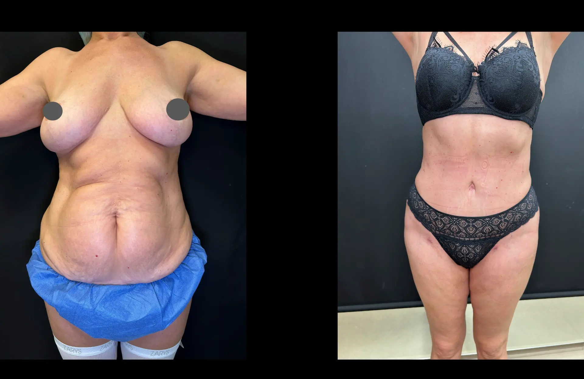 Caso 4 — Lipoabdominoplastia — Antes e depois — vista frontal