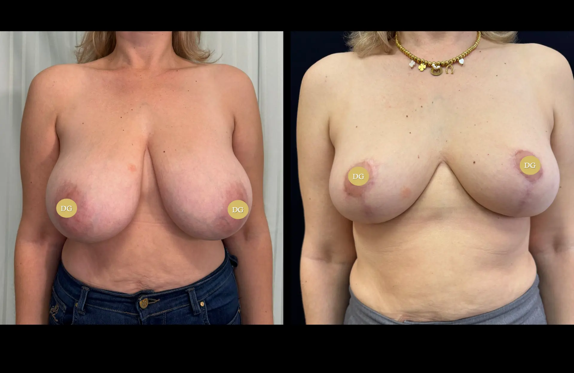 Caso 1 — Mamoplastia de redução — Antes e depois — vista frontal