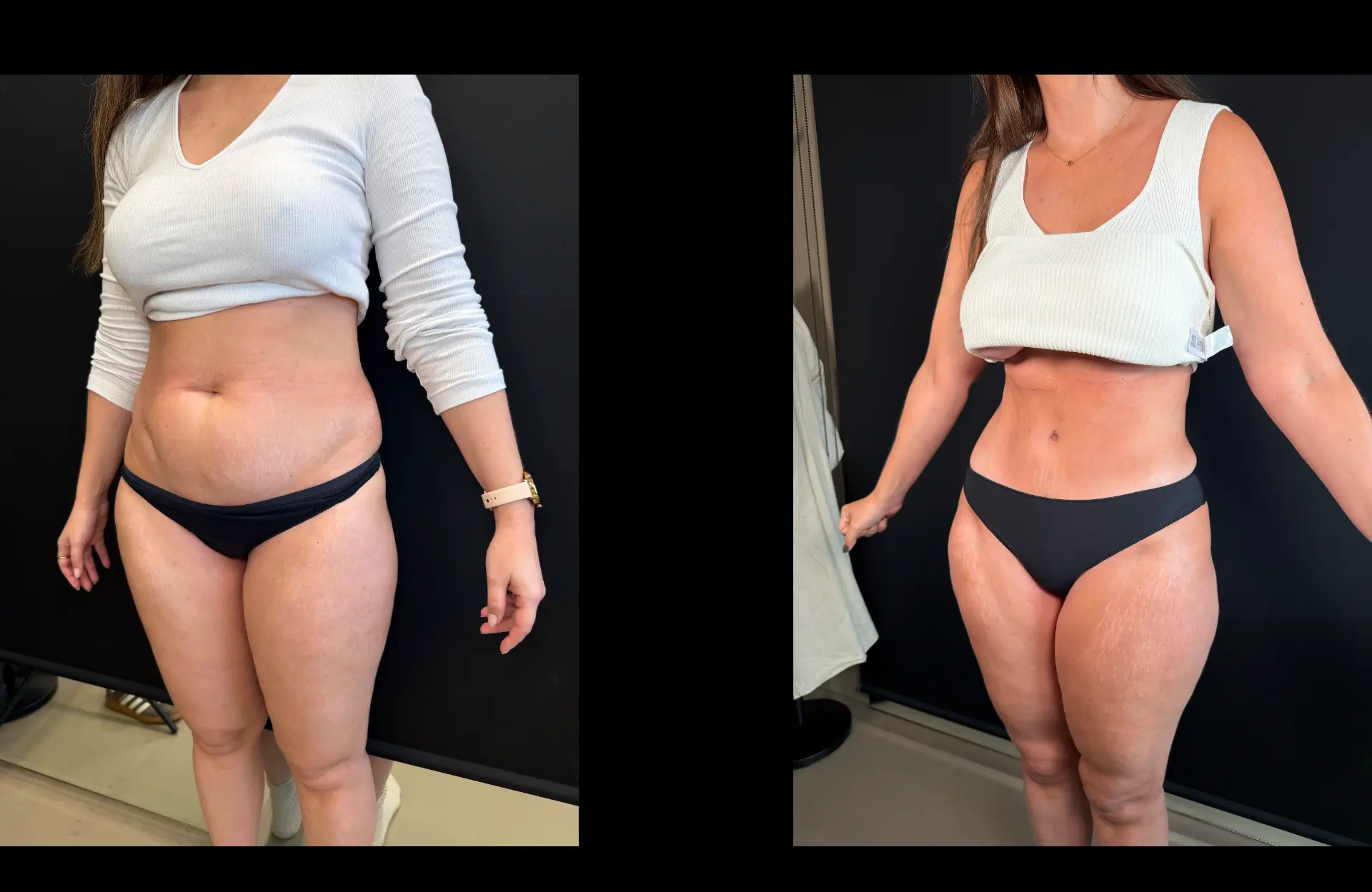 Caso 1 — Lipoabdominoplastia — Antes e depois — vista oblíqua