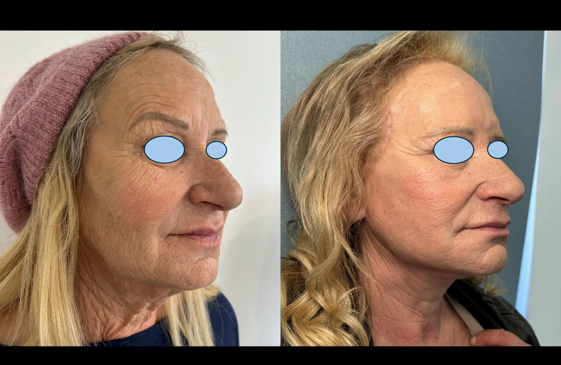 Caso 1 — Facelift cervico-facial — Antes e depois — vista oblíqua