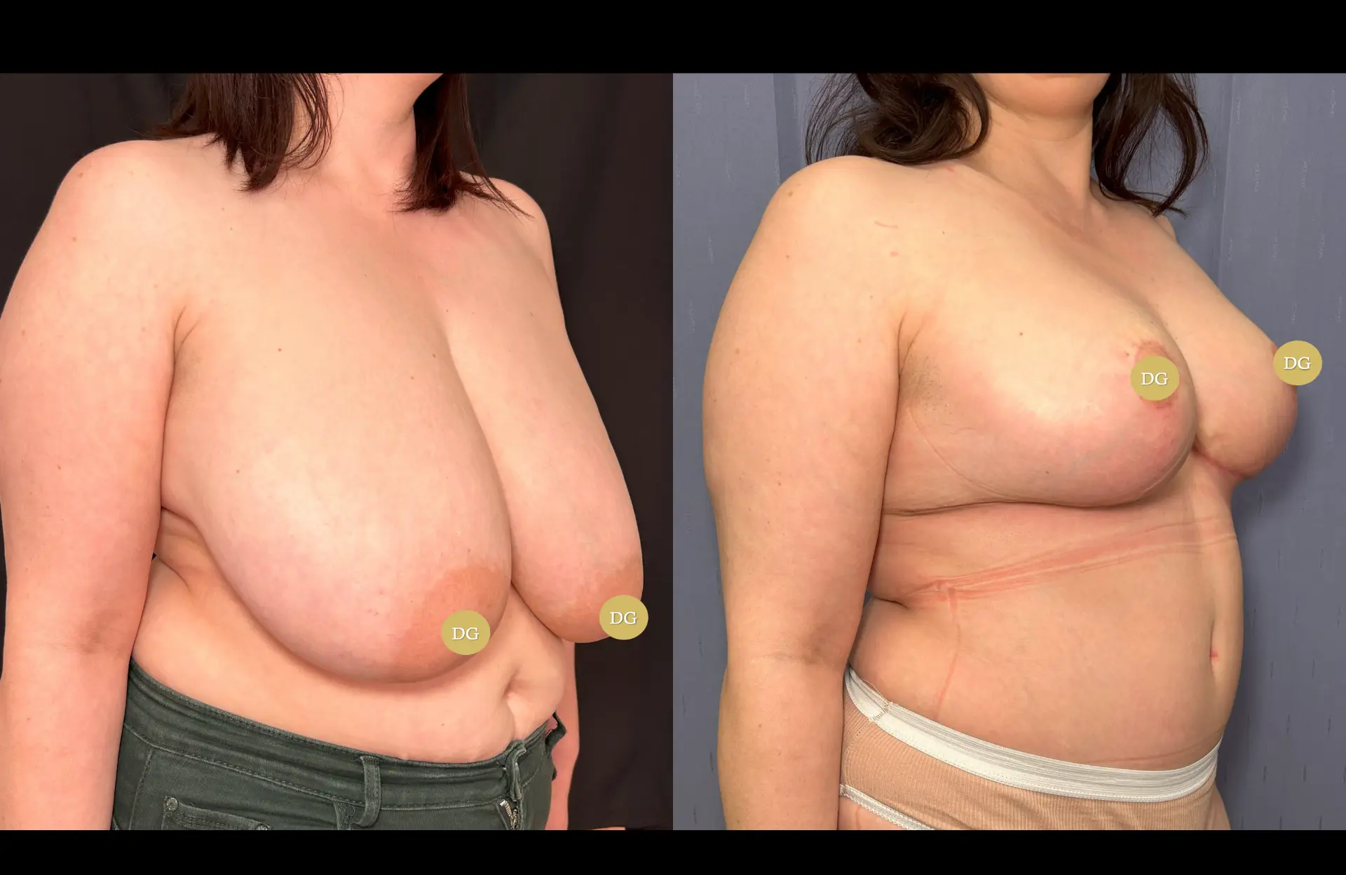 Caso 2 — Mamoplastia de redução — Antes e depois — vista oblíqua