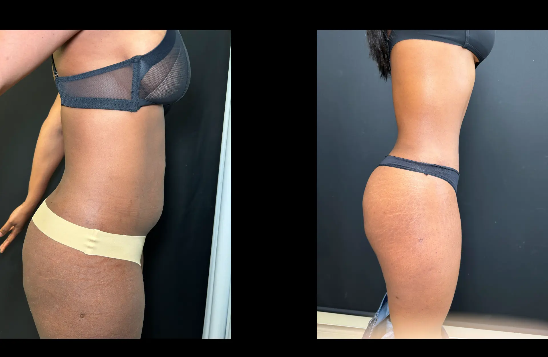 Caso 3 — Lipoabdominoplastia — Antes e depois — vista de perfil