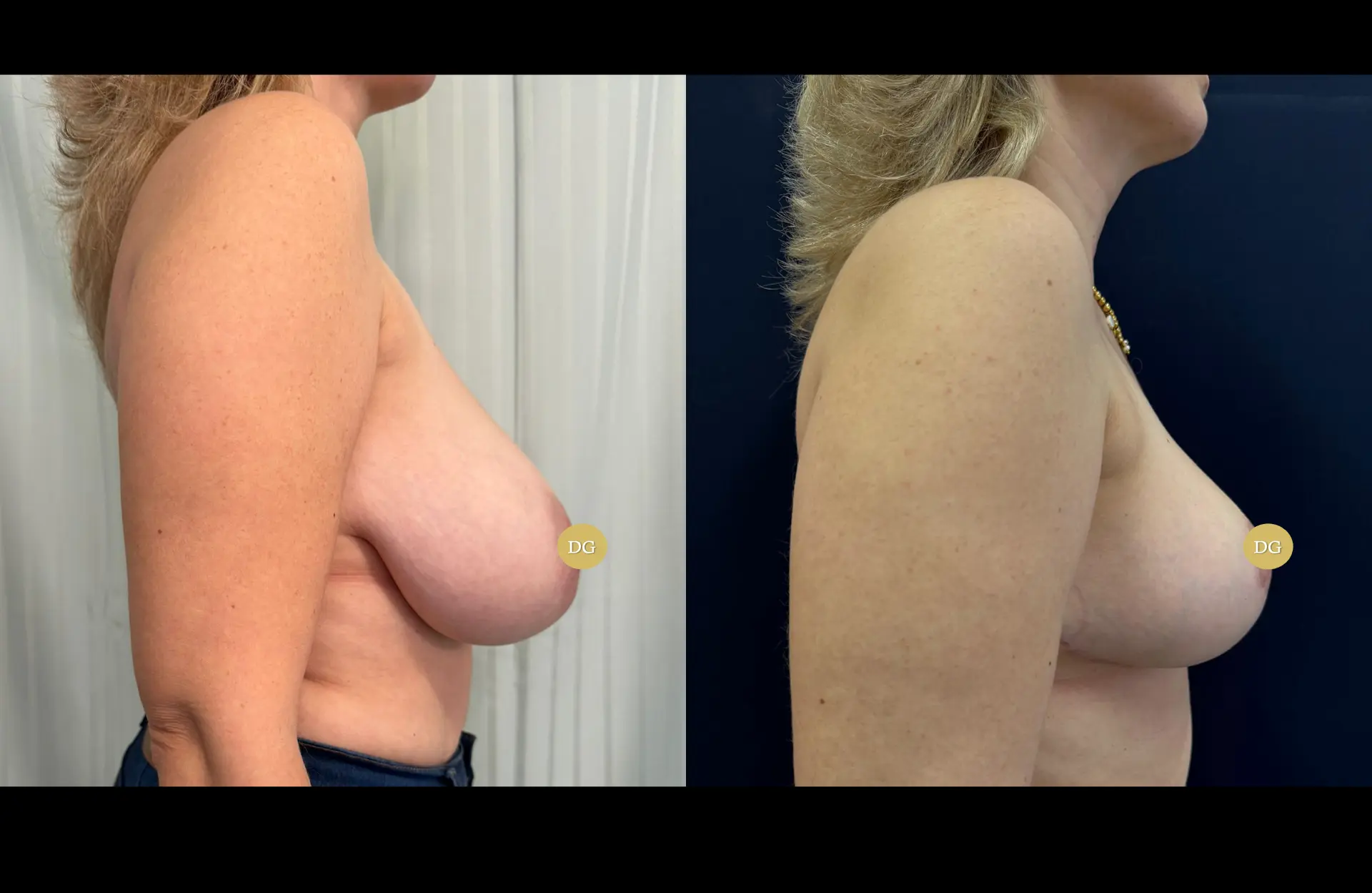Caso 1 — Mamoplastia de redução — Antes e depois — vista de perfil