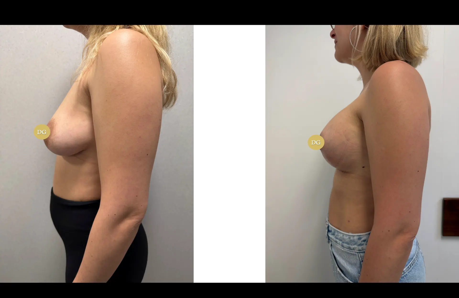 Caso 3 — Mastopexia com próteses — Antes e depois — vista de perfil